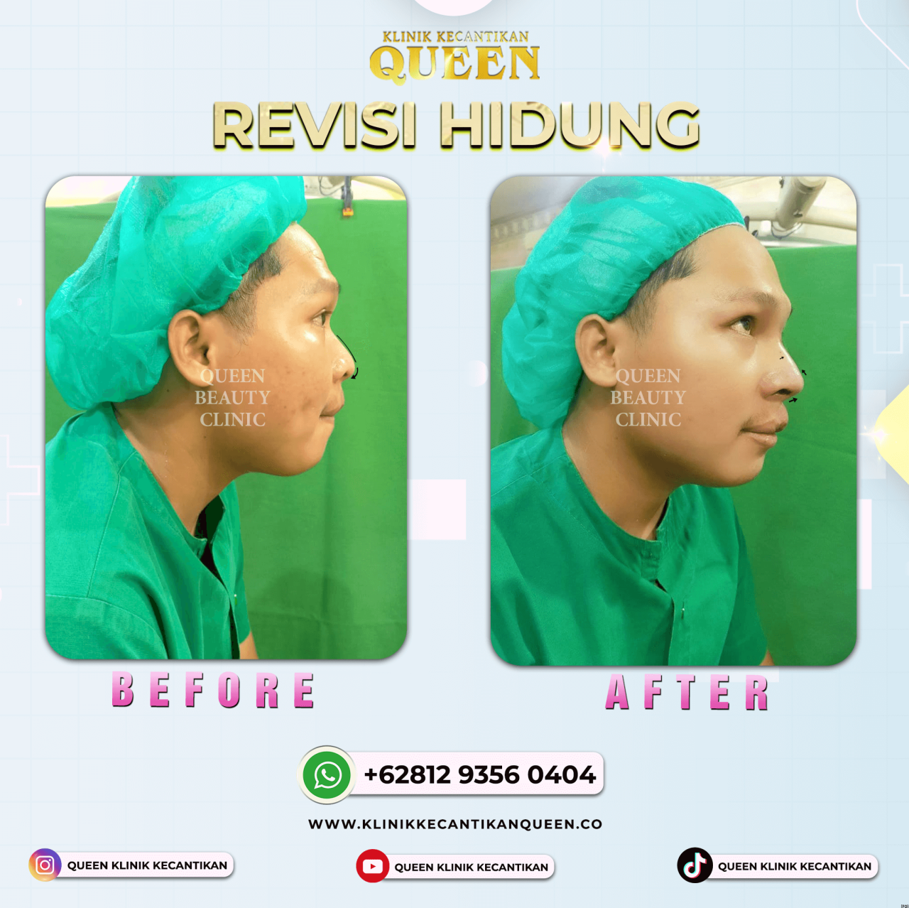 REVISI HIDUNG MAN (2)