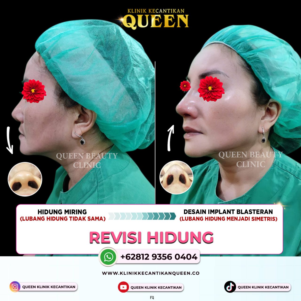REVISI HIDUNG MIRING