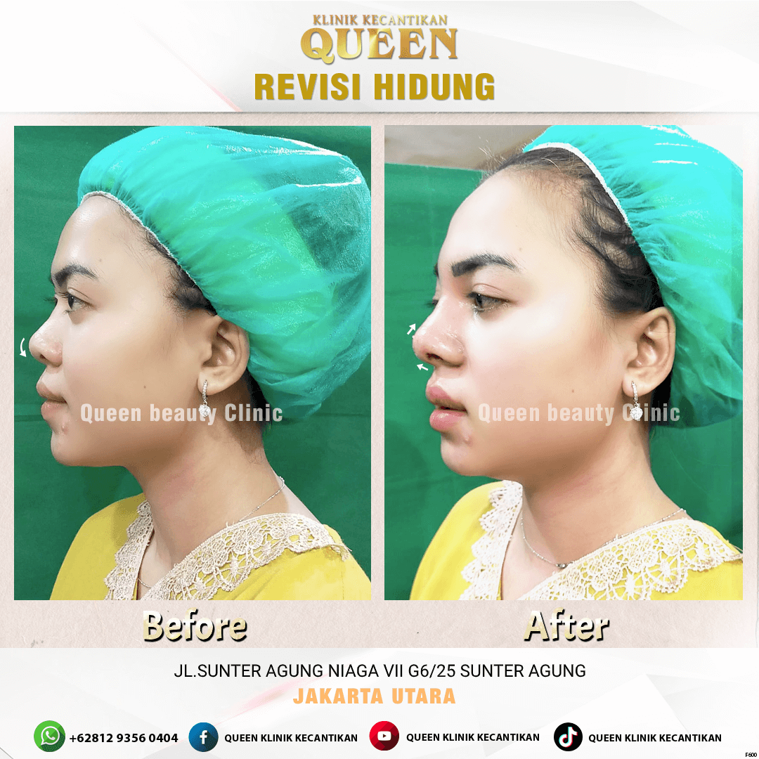 Revisi HIDUNG F600