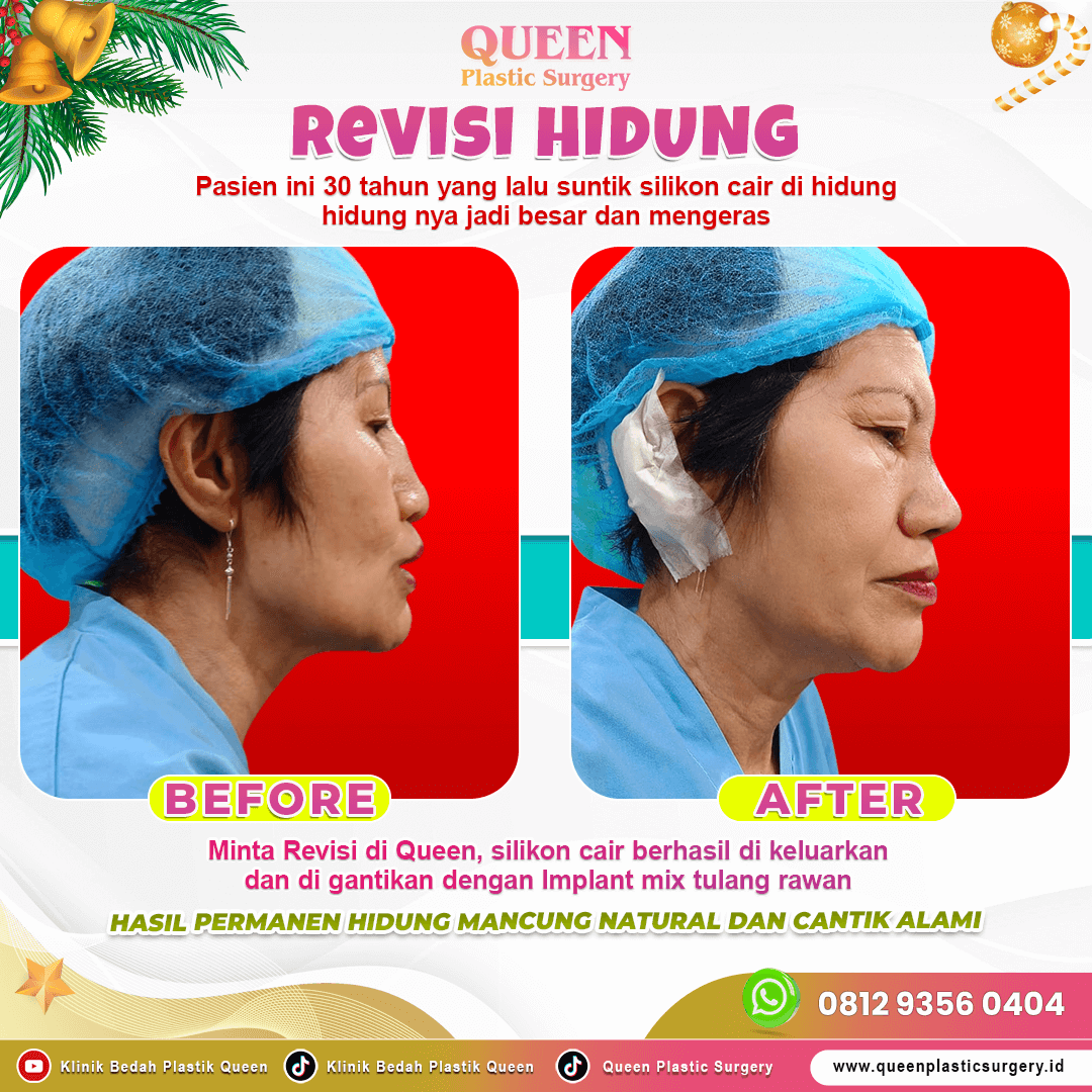 Revisi-Hidung-001