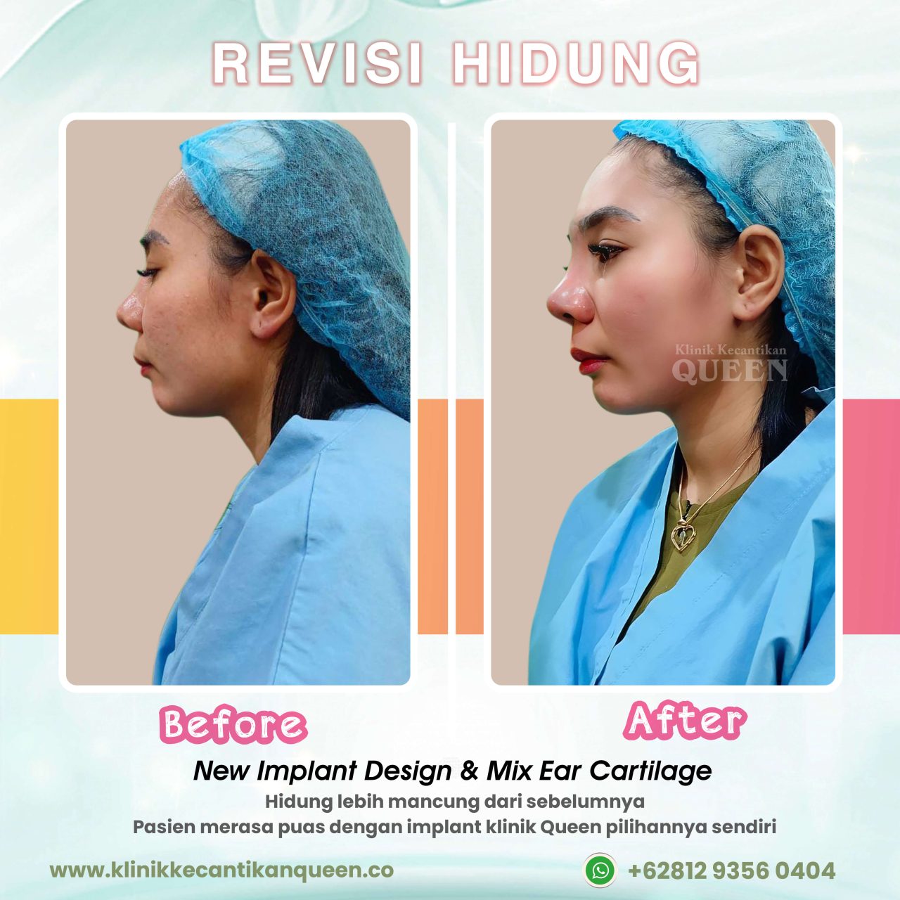 Revisi-Hidung-002 (4)