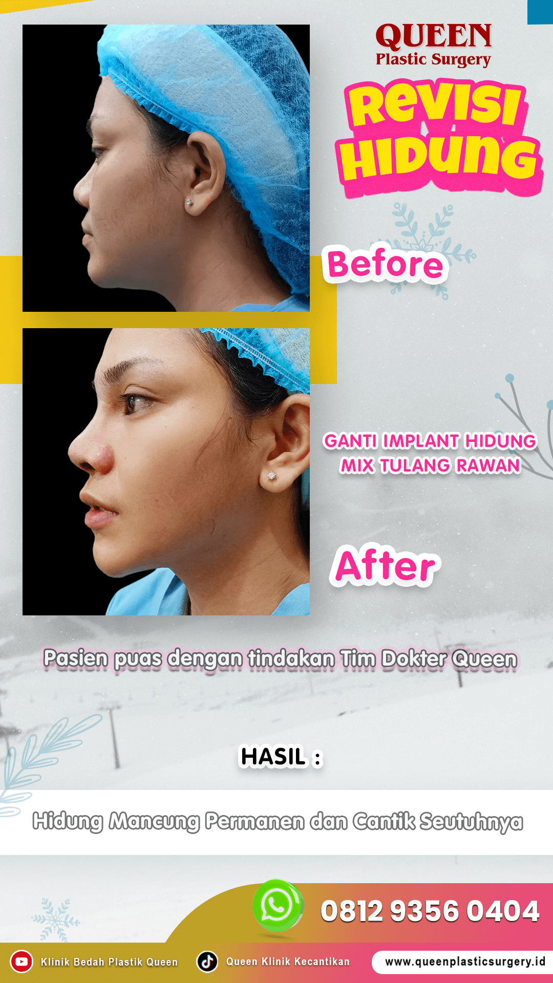 Revisi-Hidung-005