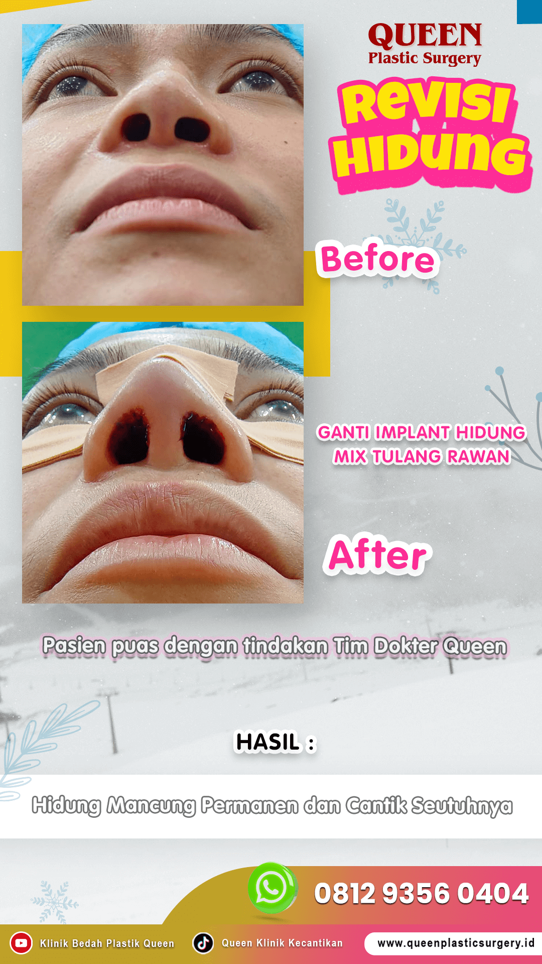 Revisi-Hidung-006