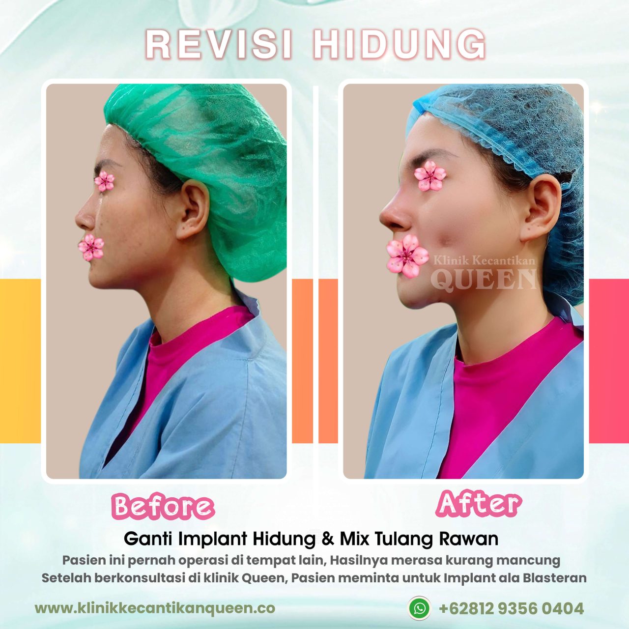 Revisi-Hidung-03 (3)