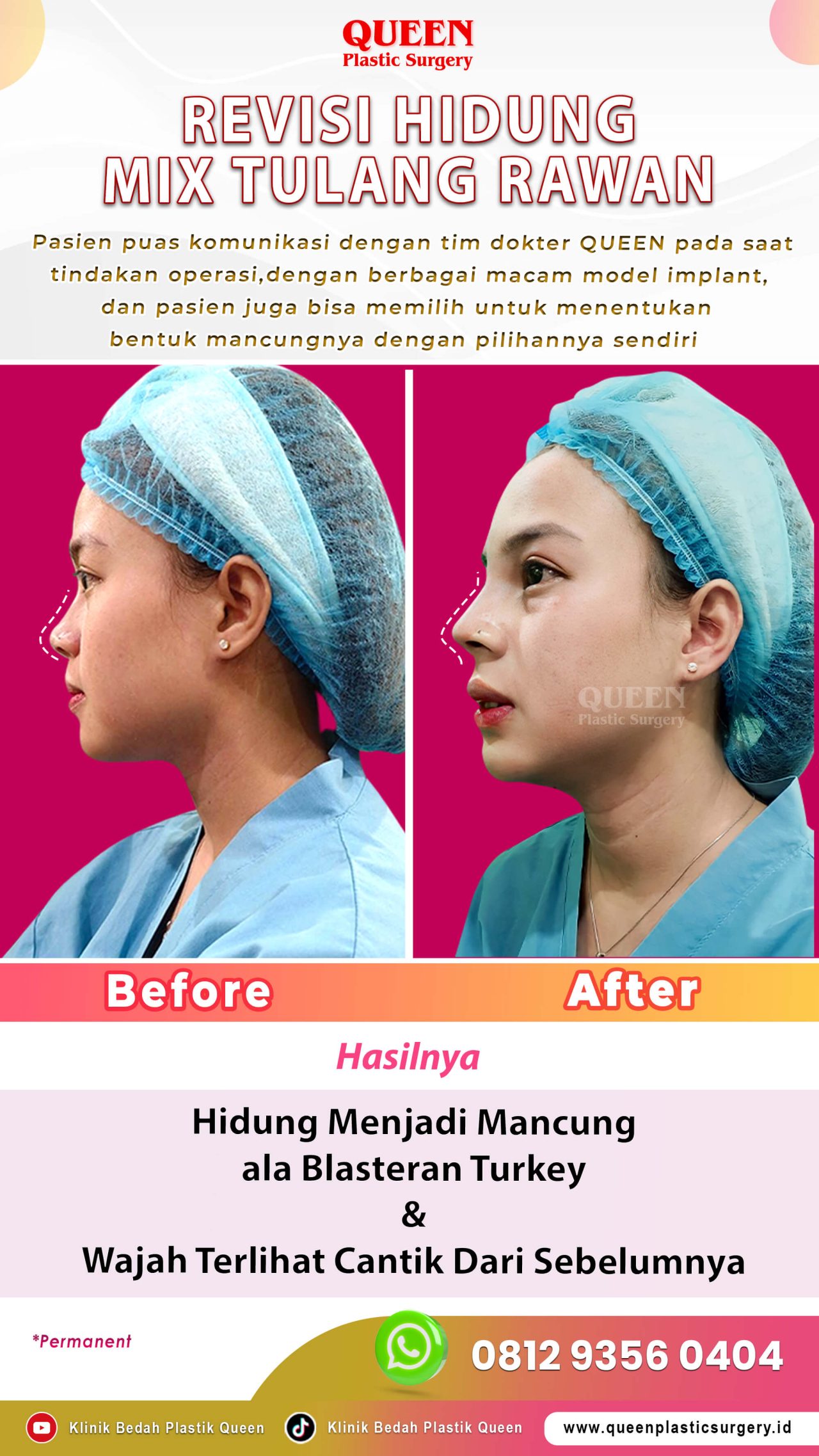 Revisi-Hidung-Blasteran-Turkey-IGS-001