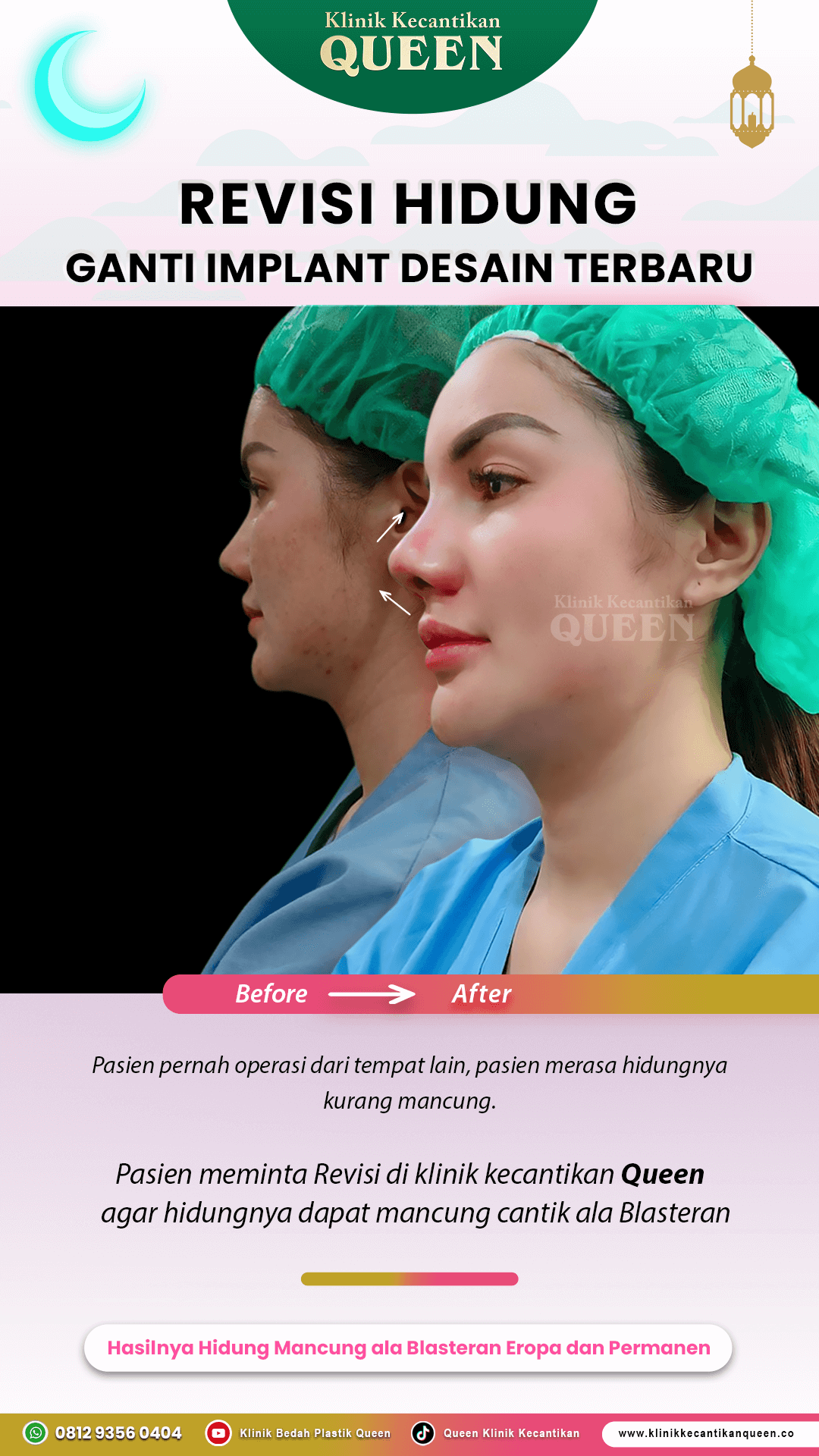 Revisi-Hidung-Ganti-Implant-IG-Story01