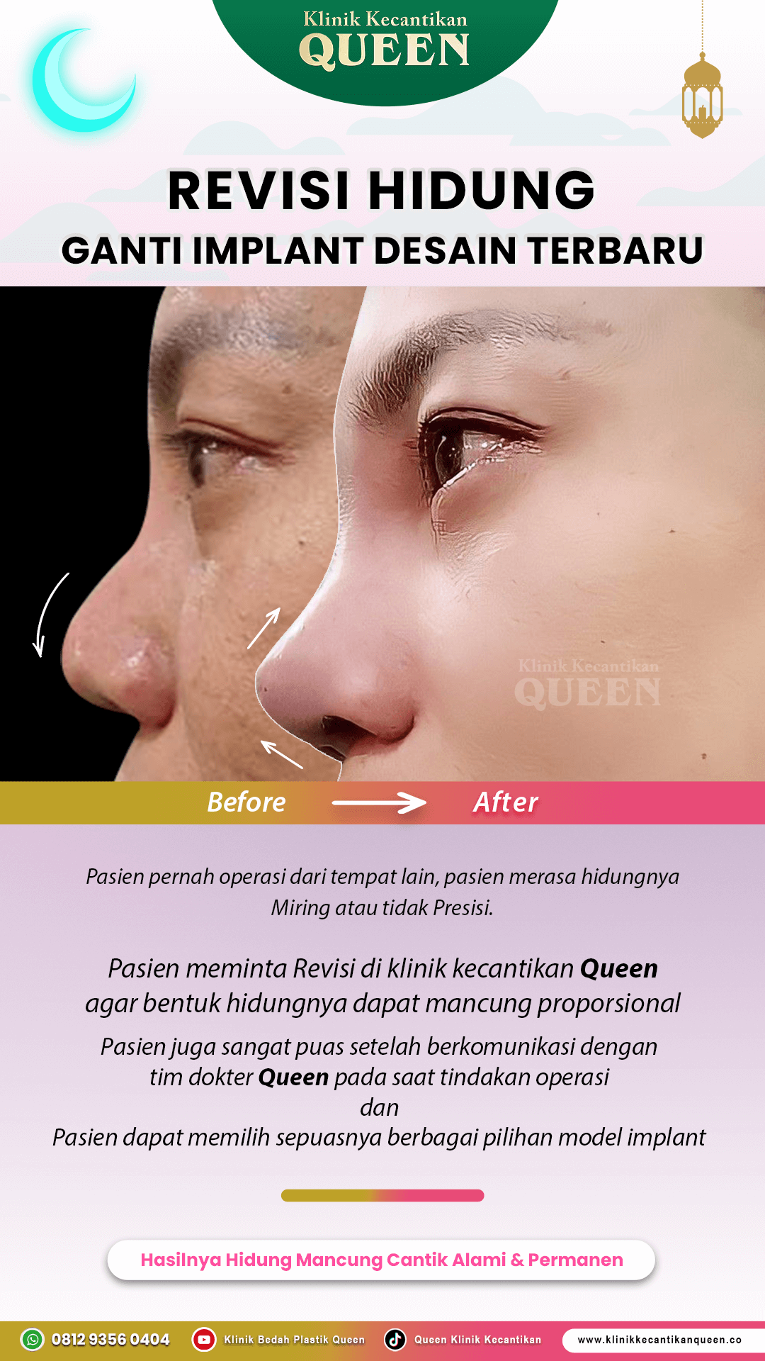 Revisi-Hidung-Ganti-Implant-IG-Story16