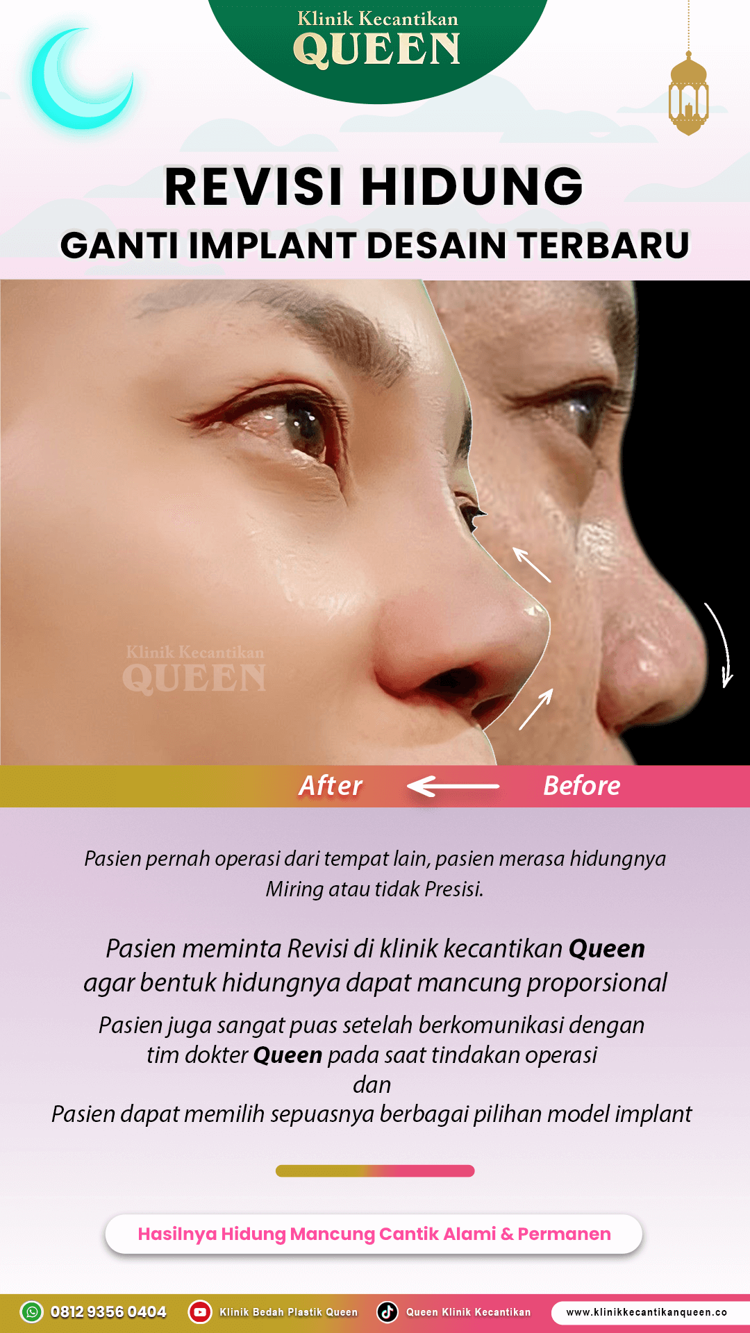 Revisi-Hidung-Ganti-Implant-IG-Story17