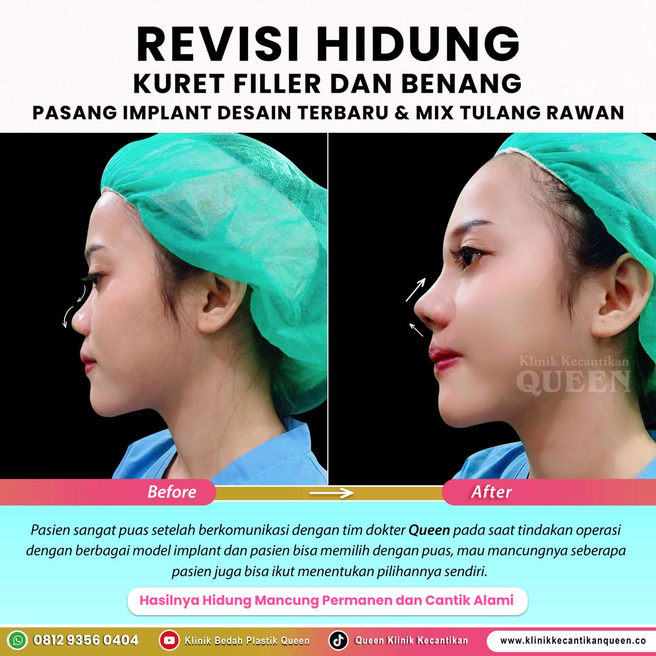 Revisi-Hidung-IG-Feed-New03