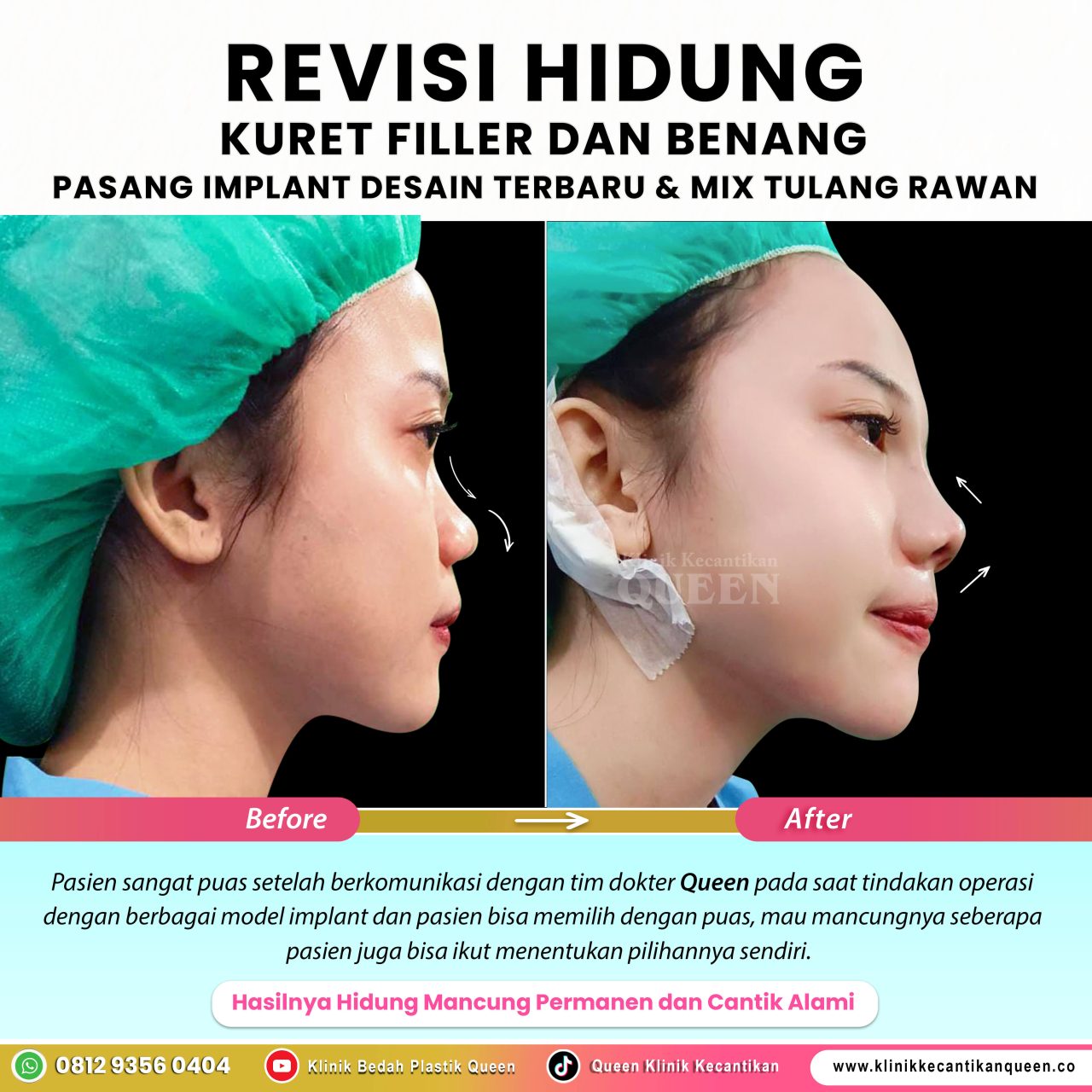 Revisi-Hidung-IG-Feed-New04