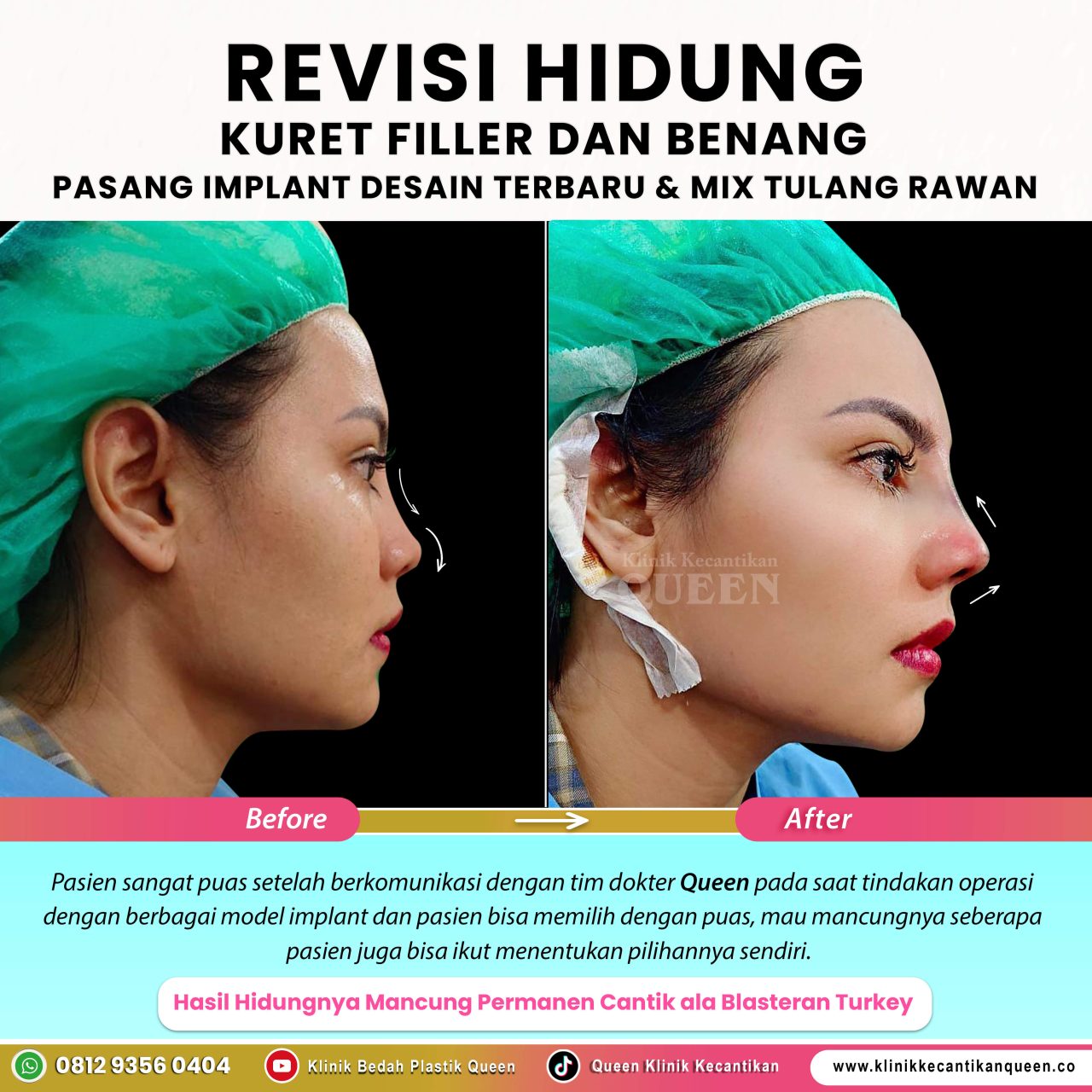 Revisi-Hidung-IG-Feed-New05