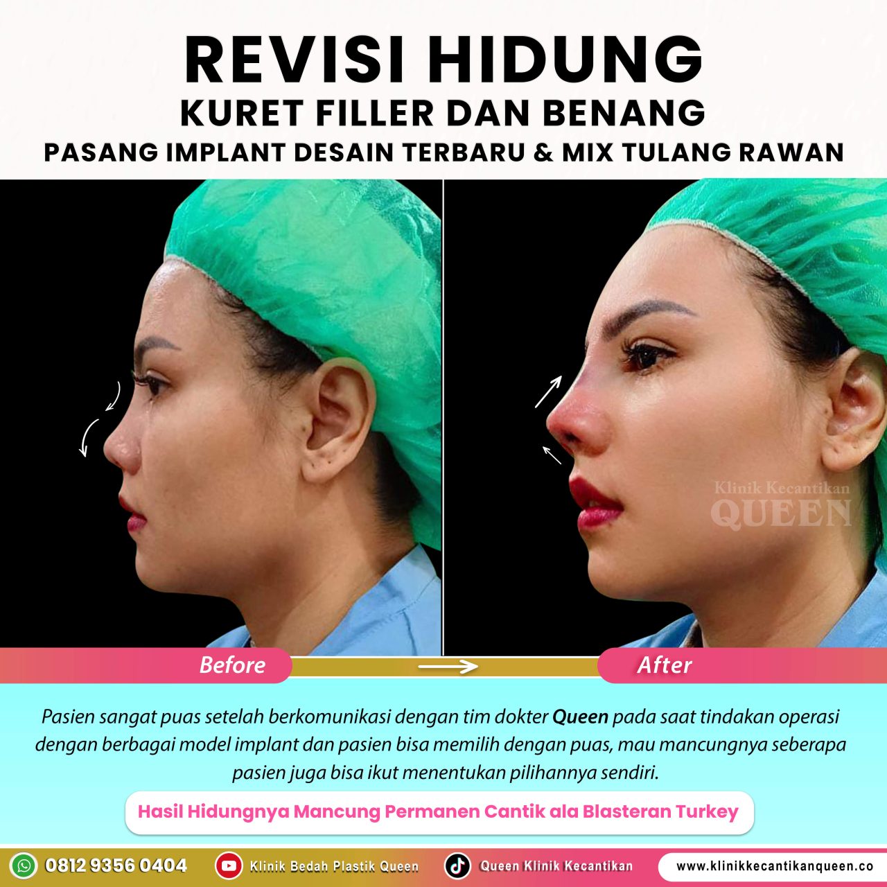 Revisi-Hidung-IG-Feed-New06