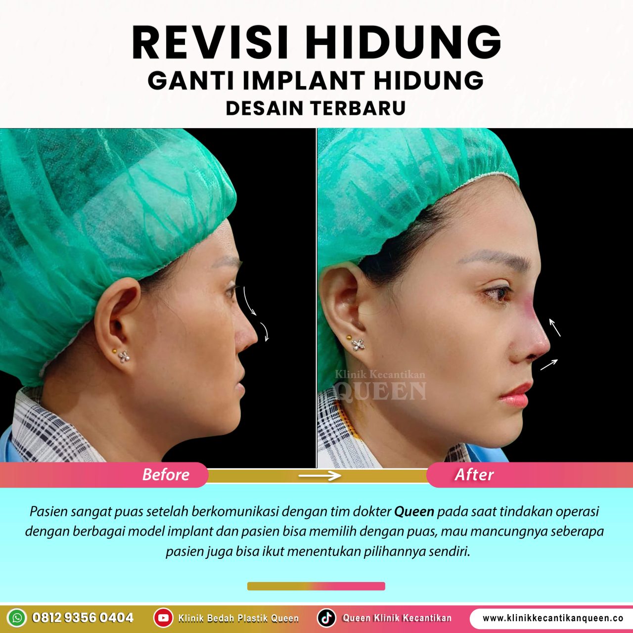 Revisi-Hidung-IG-Feed-New07