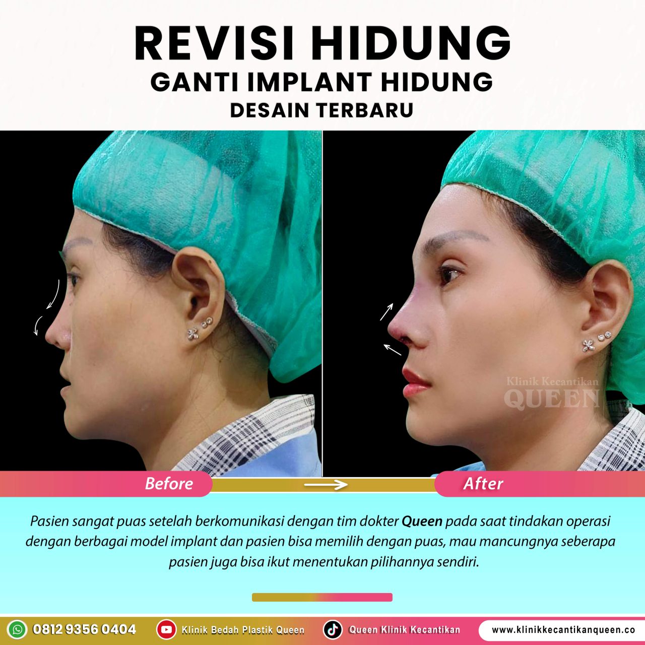 Revisi-Hidung-IG-Feed-New08