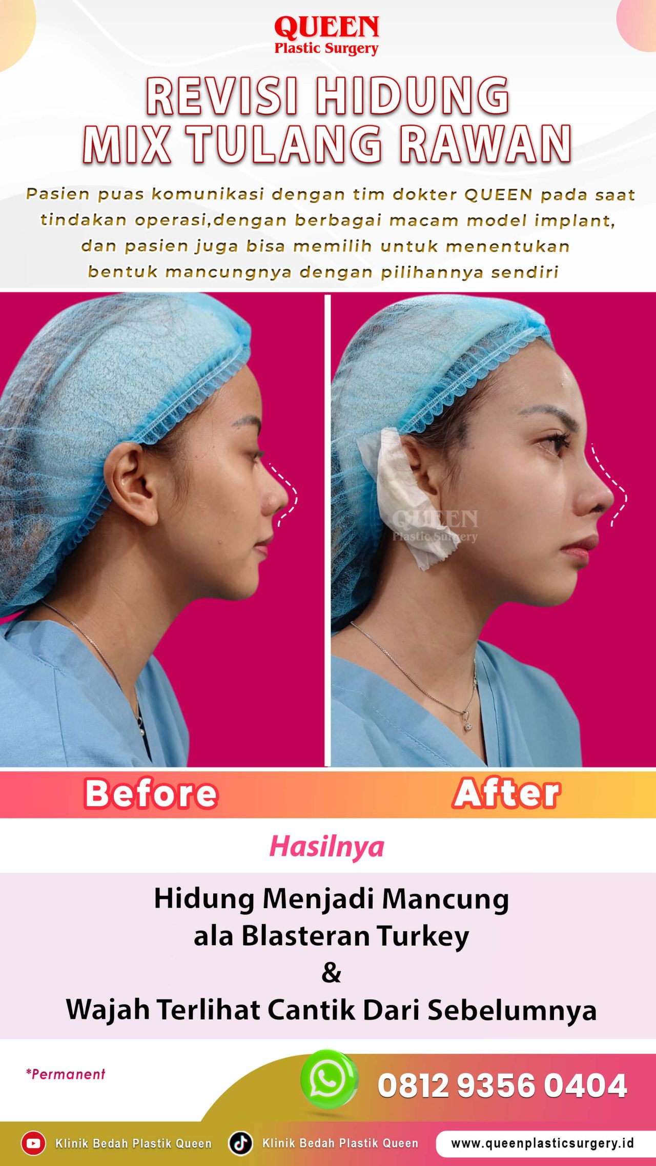 Revisi-Hidung-IG-Story-002 (2)