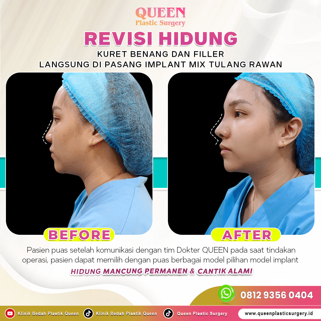 Revisi-Hidung-IGF-001