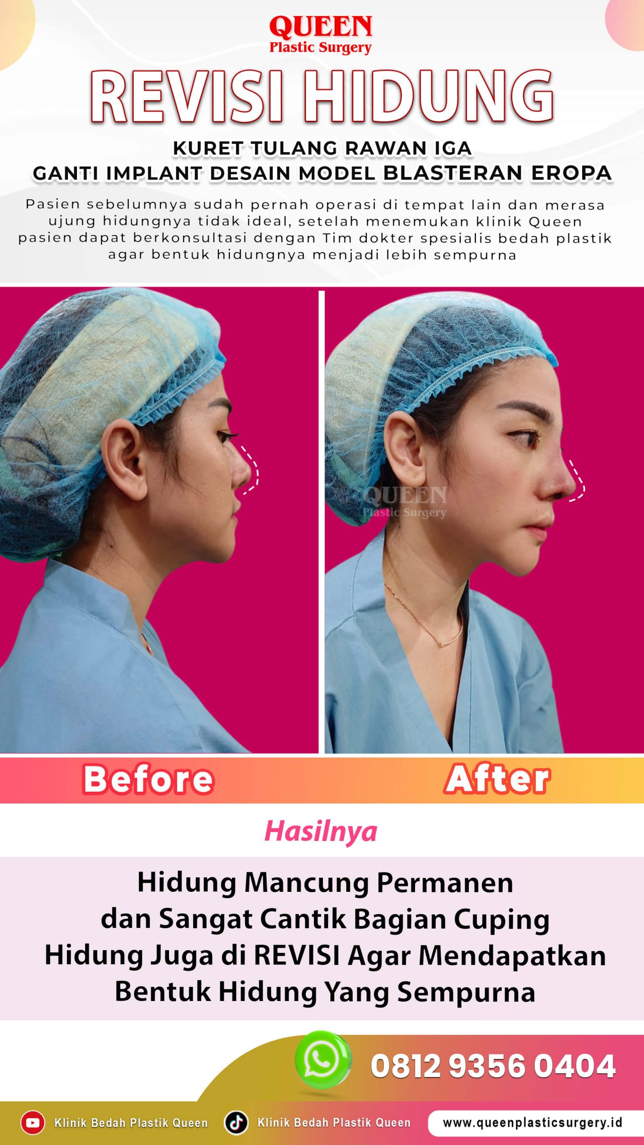 Revisi-Hidung-Implant-Blasteran-IGS-001
