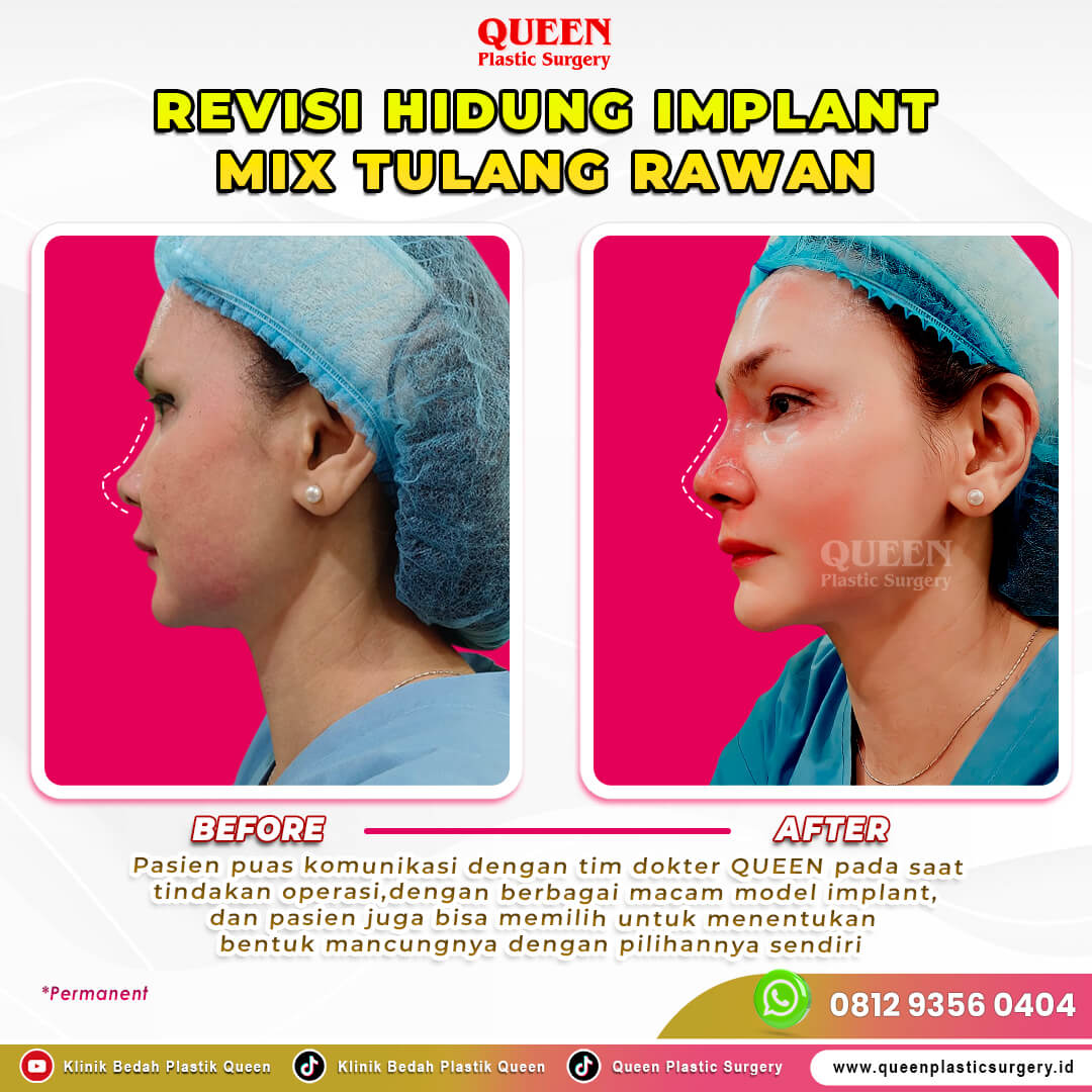 Revisi-Hidung-Kuret-Benang-Implant-Turkey-Models-002