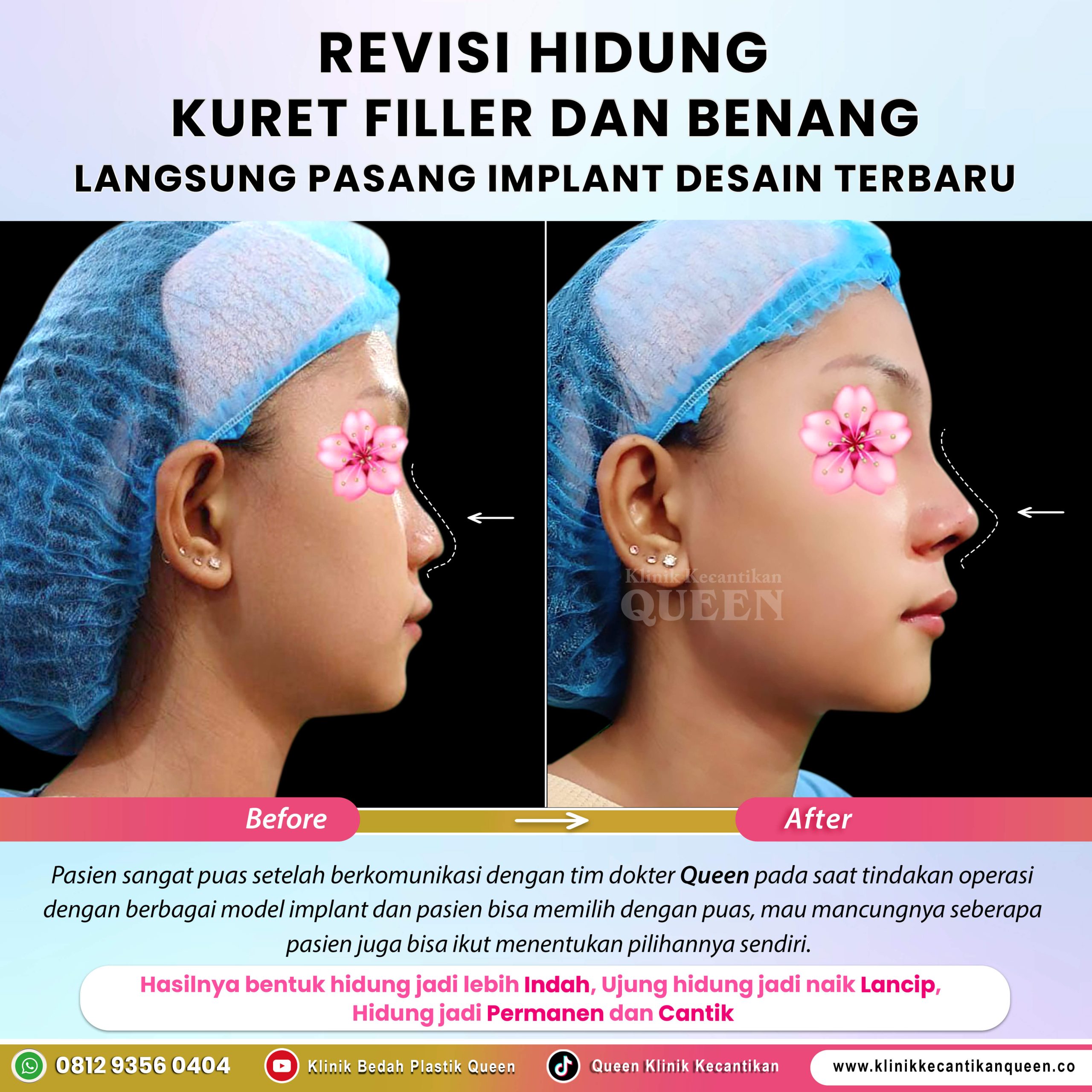 Revisi-Hidung-Kuret-Filler-&-Benang-002