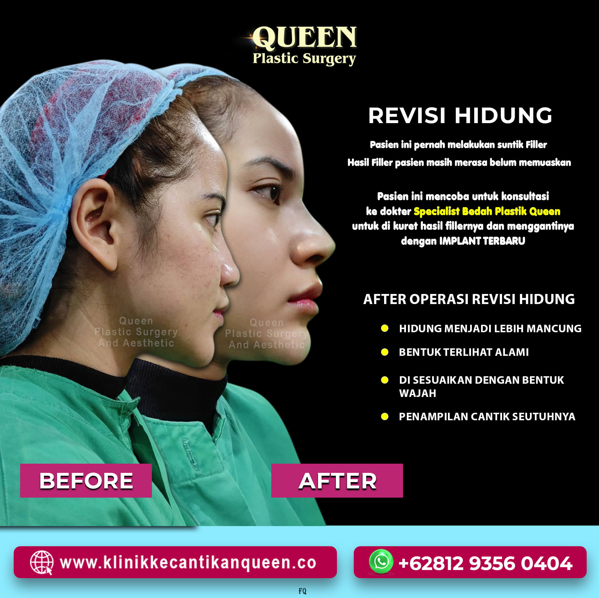 Revisi-Hidung-Kuret-Filler