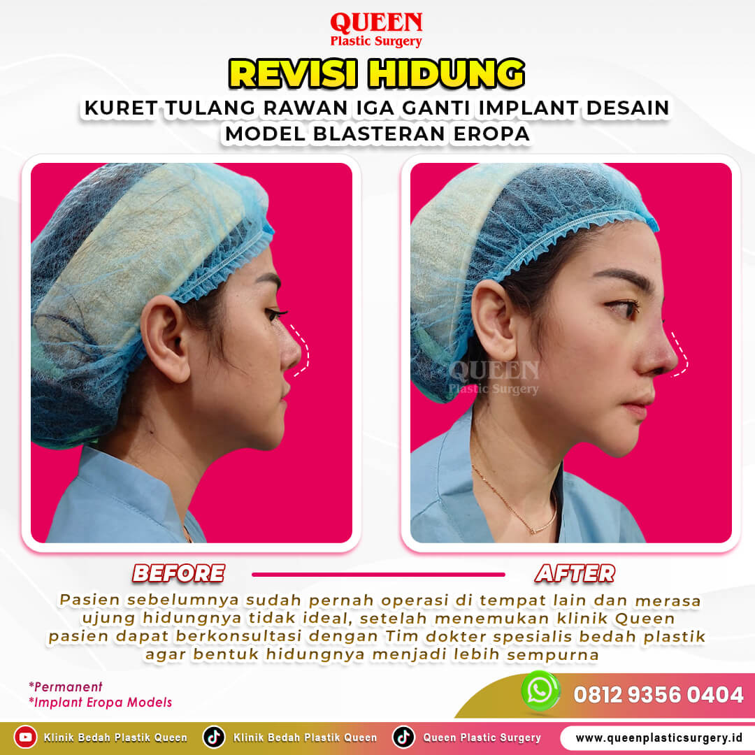 Revisi-Hidung-Kuret-tulang-Iga-Ganti-Implant-Blasteran-Eropa