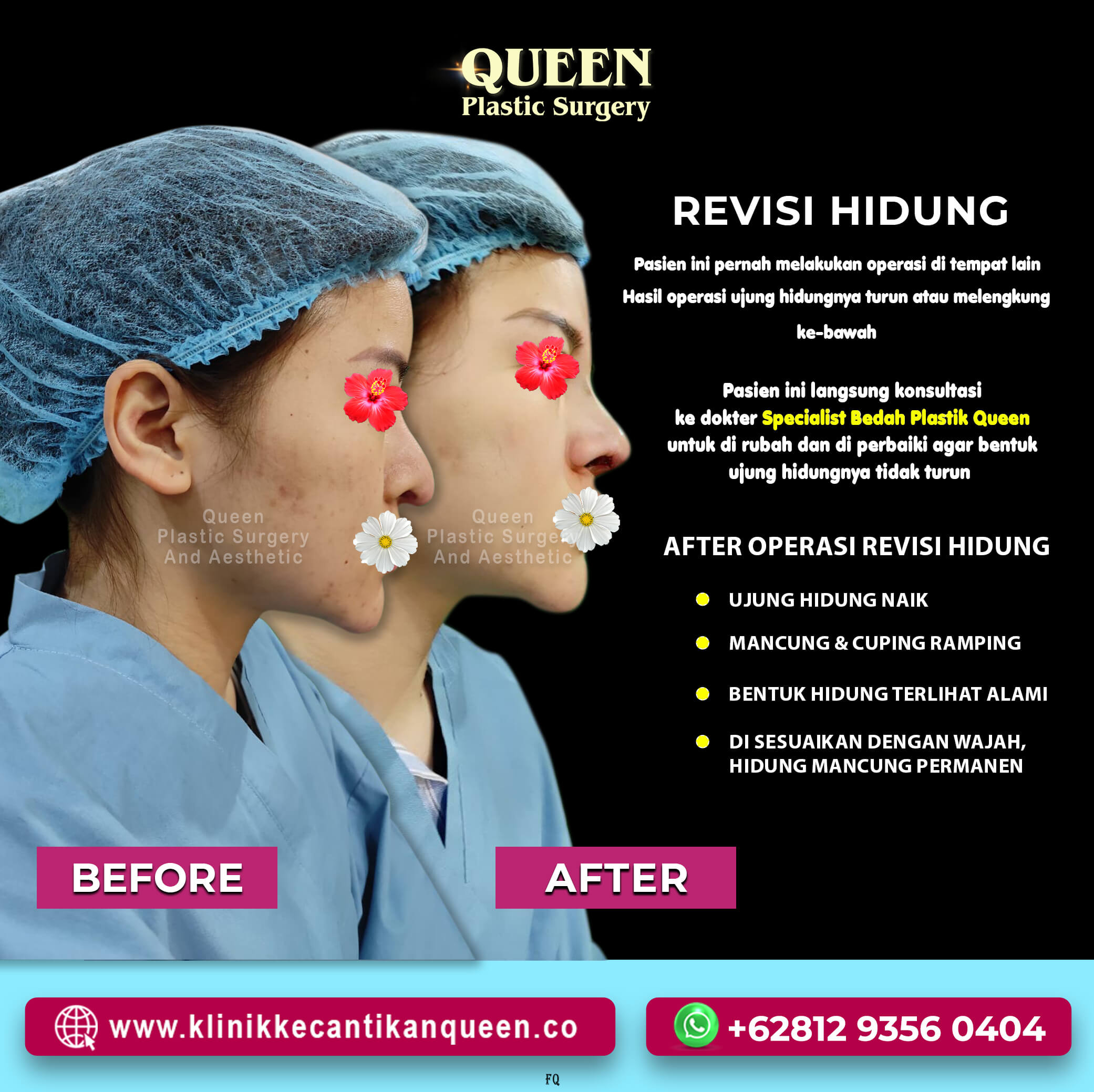 Revisi-Hidung-Melengkung-Ke-Bawah