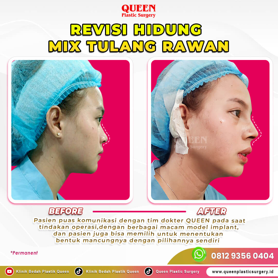 Revisi-Hidung-Mix-Tulang-Rawan-002