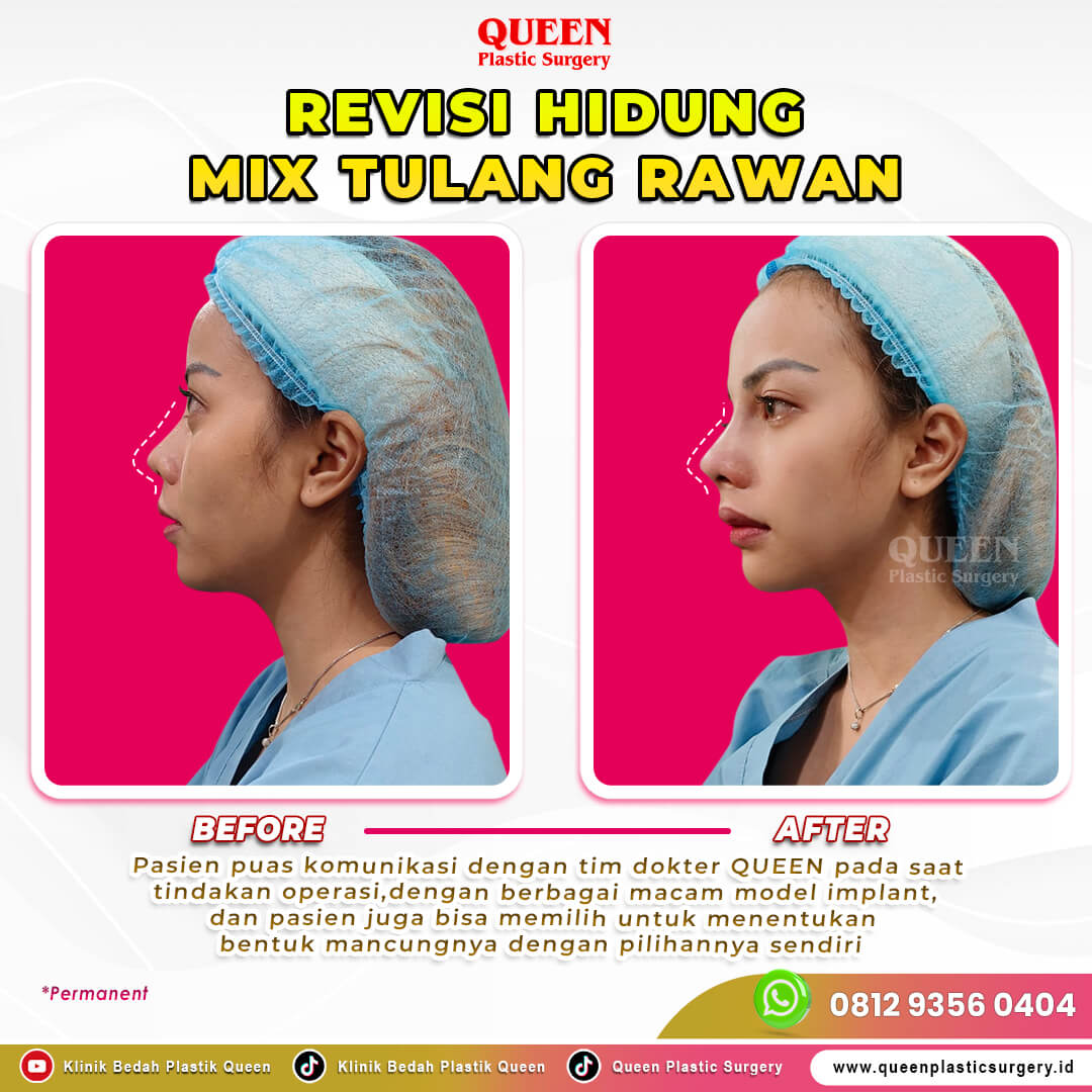 Revisi-Hidung-Mix-Tulang-Rawan-IGF-001