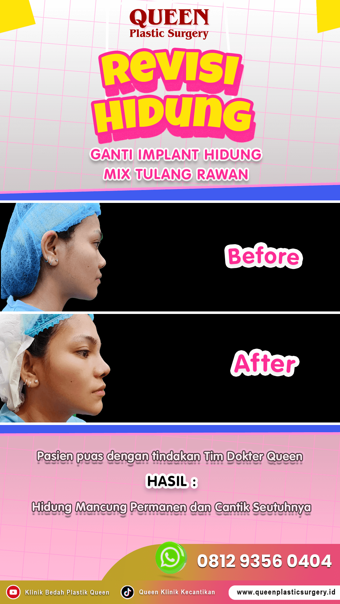 Revisi-Hidung