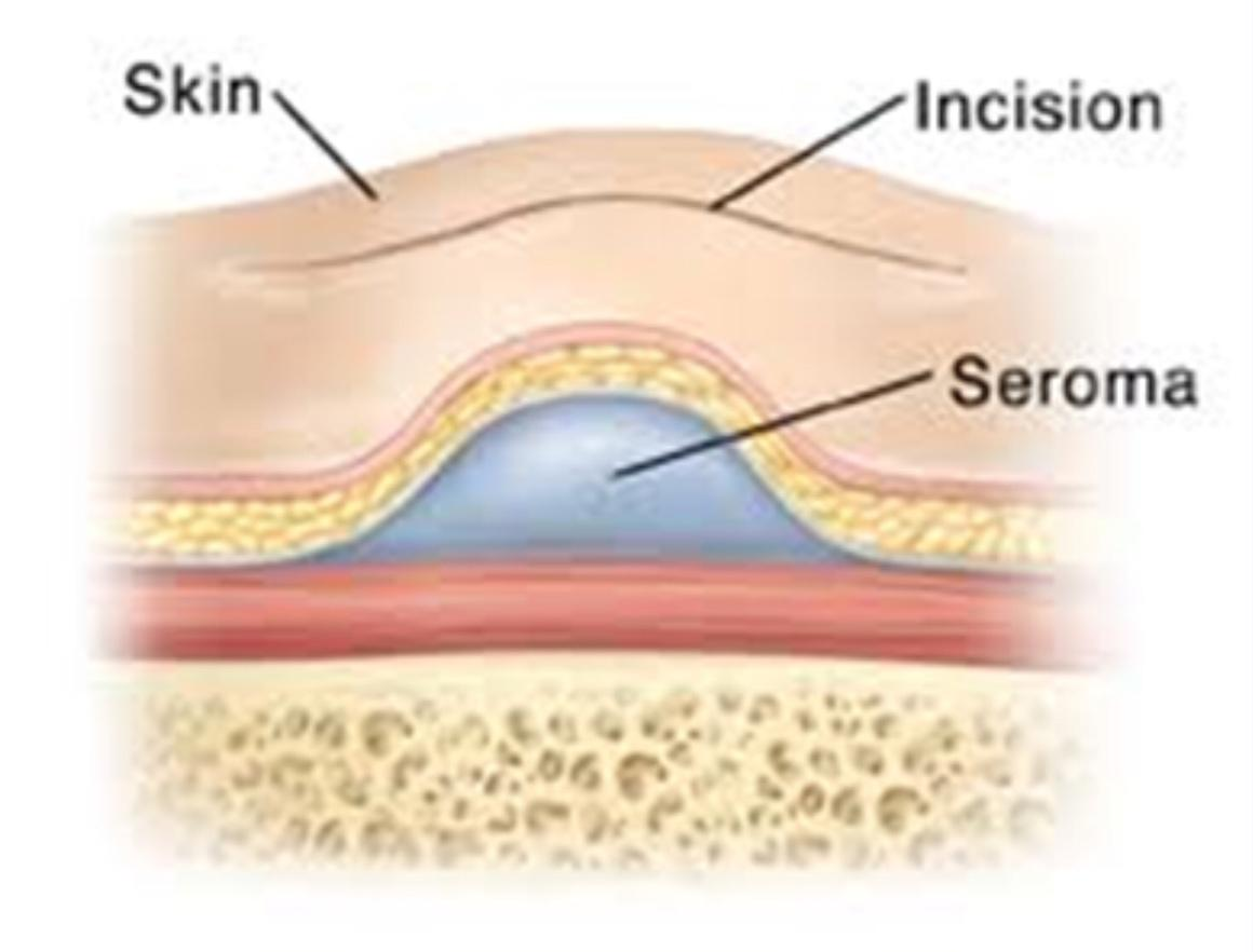 Seroma After Tummy Tuck Pictures