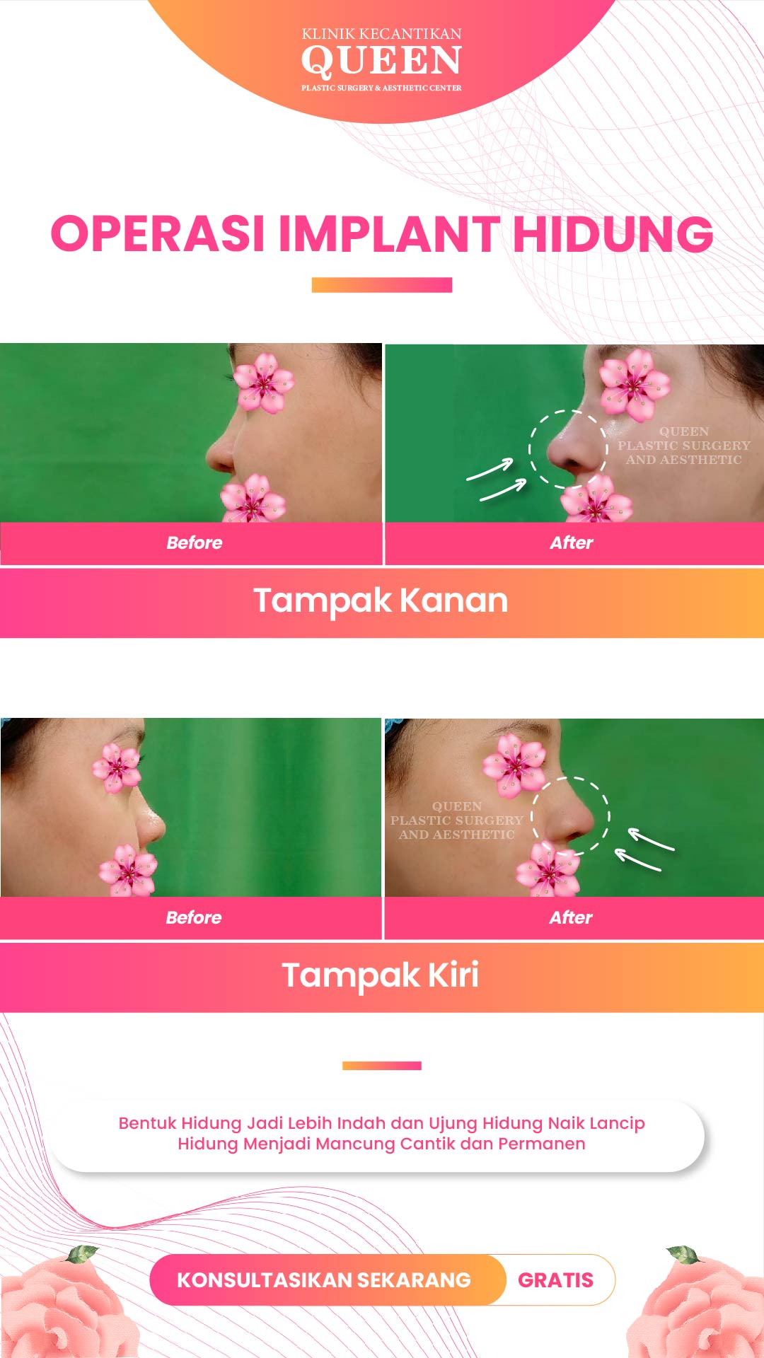Hasil Rhinoplasty Queen Plastic Surgery, foto 4
