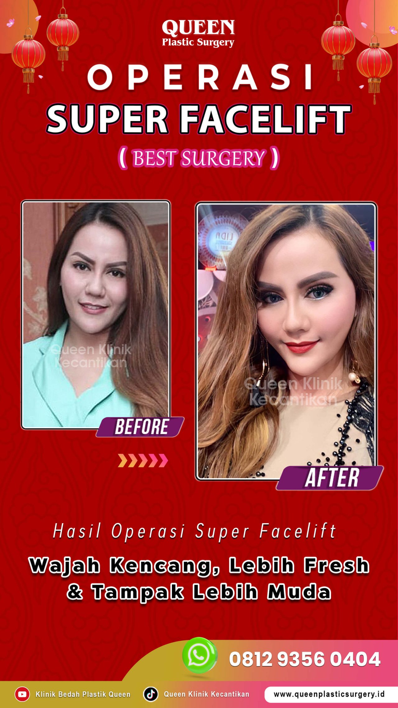 Hasil Rhinoplasty Queen Plastic Surgery, foto 90