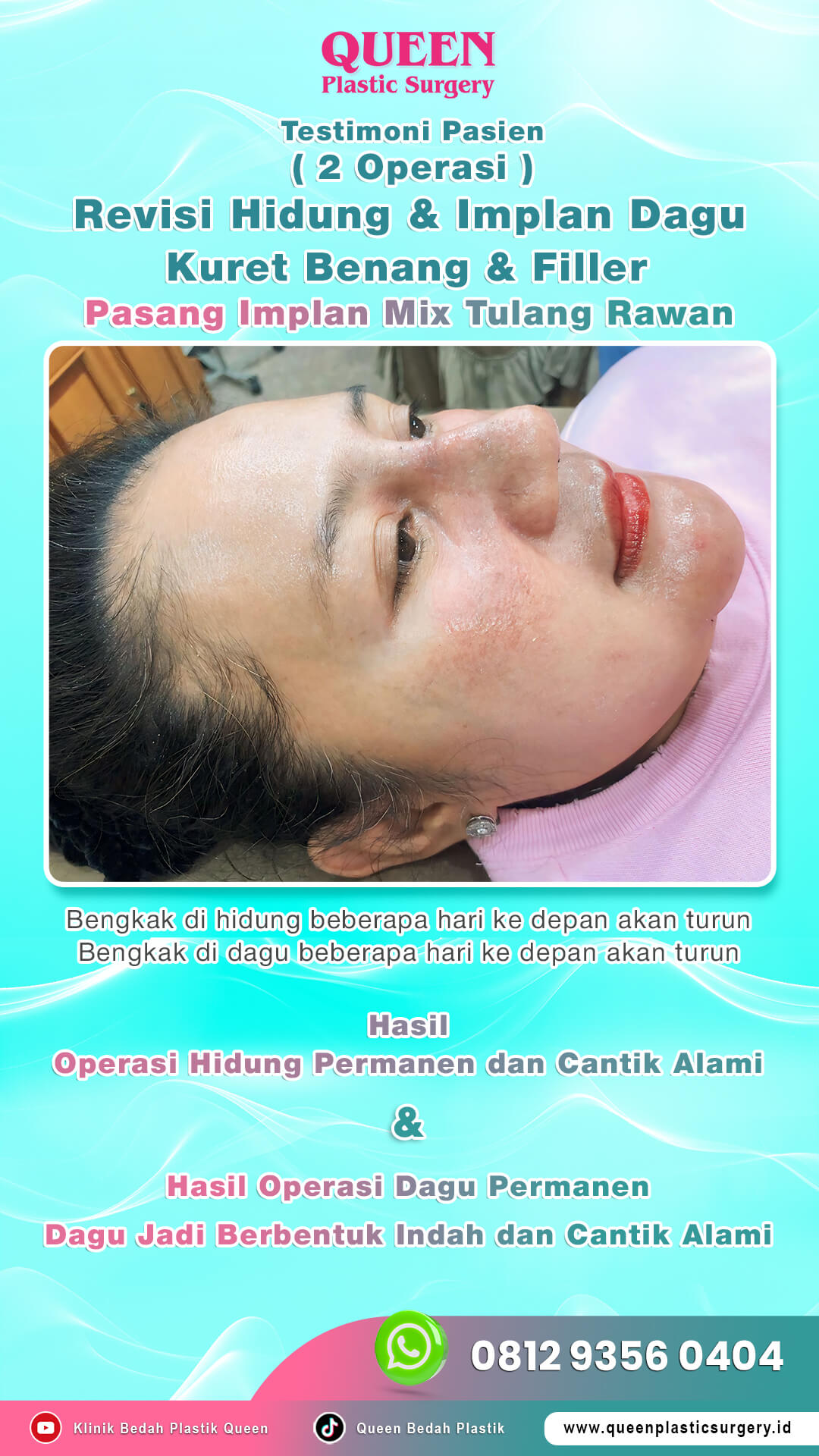 Terstimoni-Pasien-2-Operasi-Rev-Hidung-n-Implan-Dagu (1)