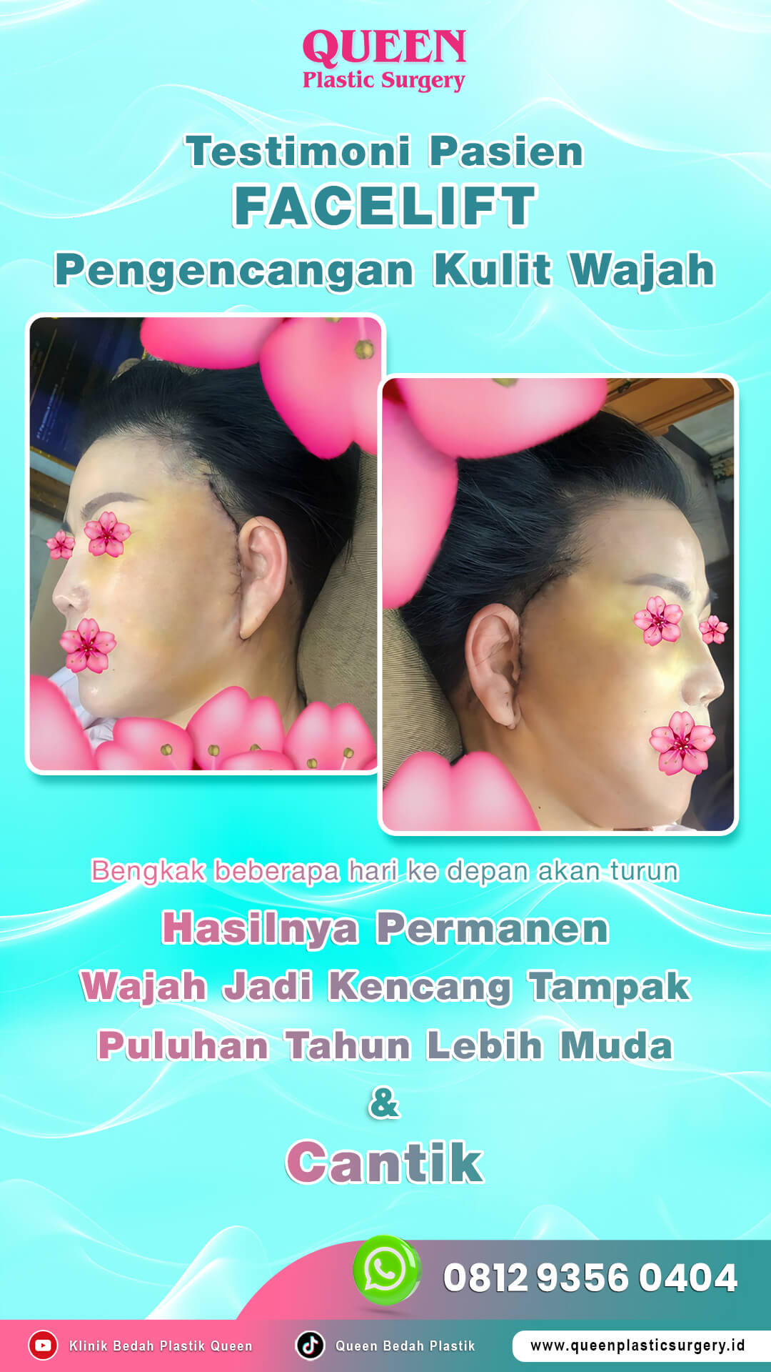 Hasil Rhinoplasty Queen Plastic Surgery, foto 97