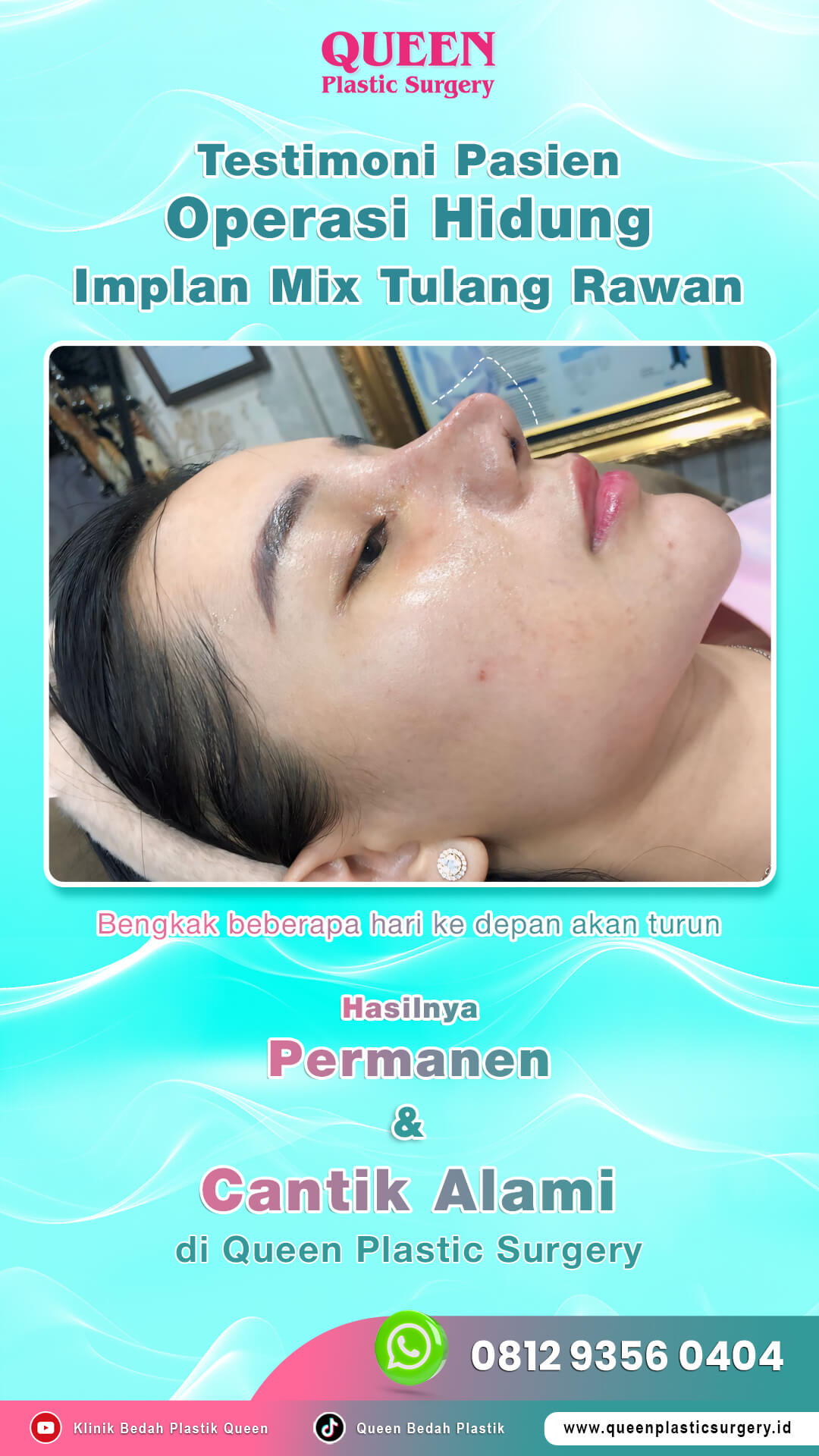 Terstimoni-Pasien-Operasi-Hidung (1)