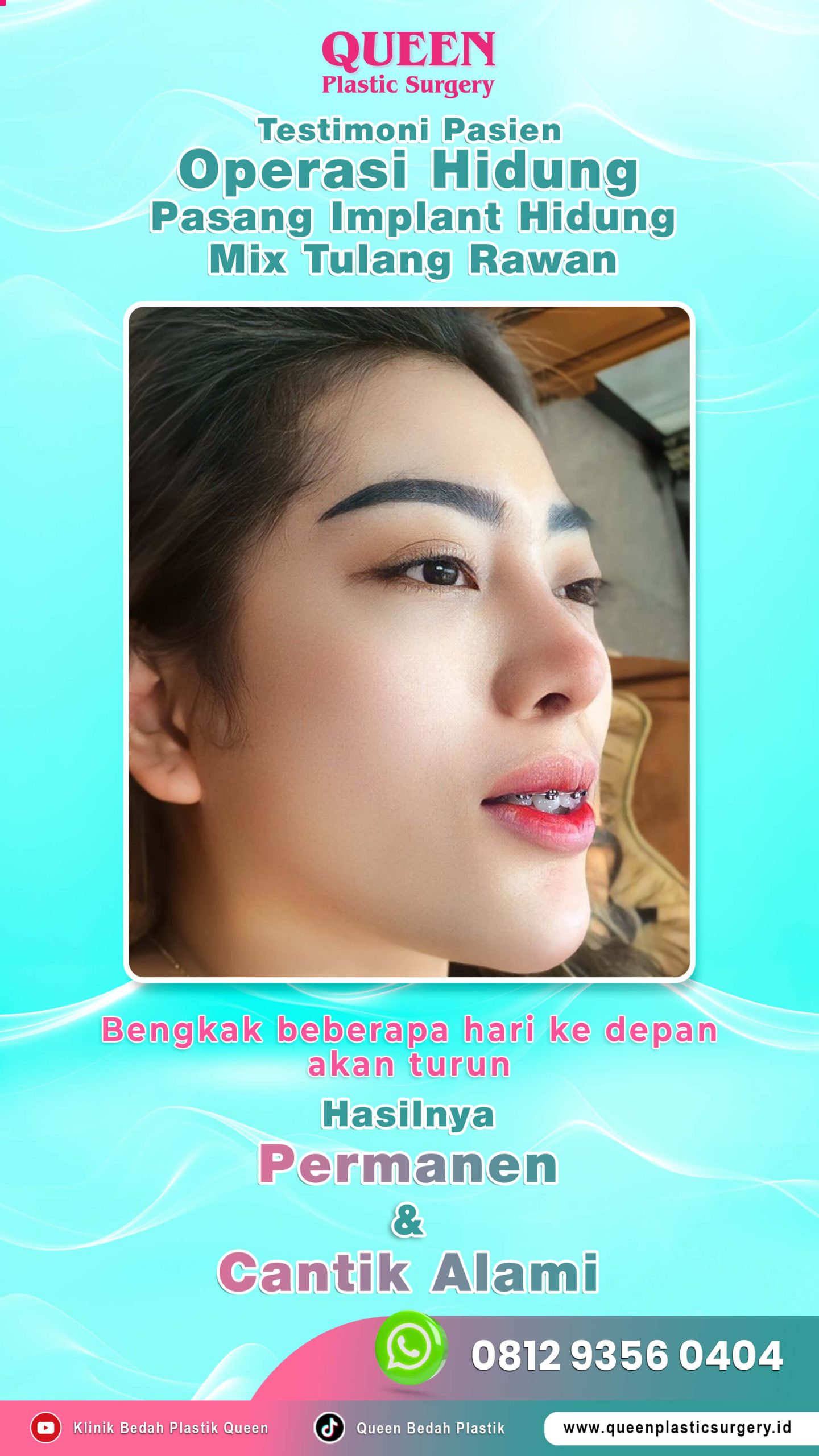 Testimoni-Pasien-Operasi-Hidung-Queen (1)