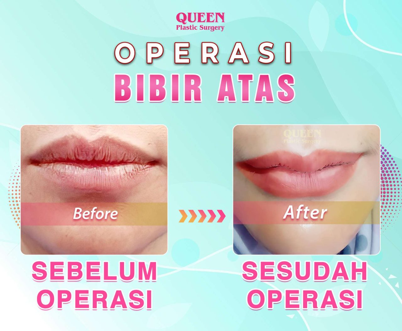 Tugas-Wajib-Alina-BA-Bibir-Atas-02-web-fotor-20240515113313 Tugas-Wajib-Alina-BA-Bibir-Atas-02-web-fotor-20240515113313