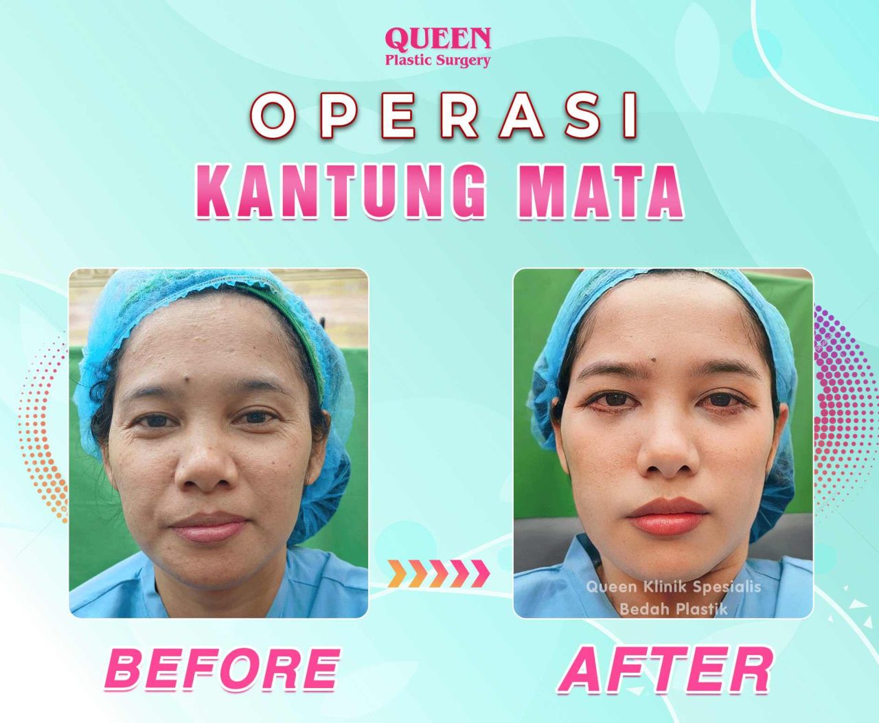 Tugas-Wajib-Alina-BA-Kantung-Mata-web-fotor-20240515113445