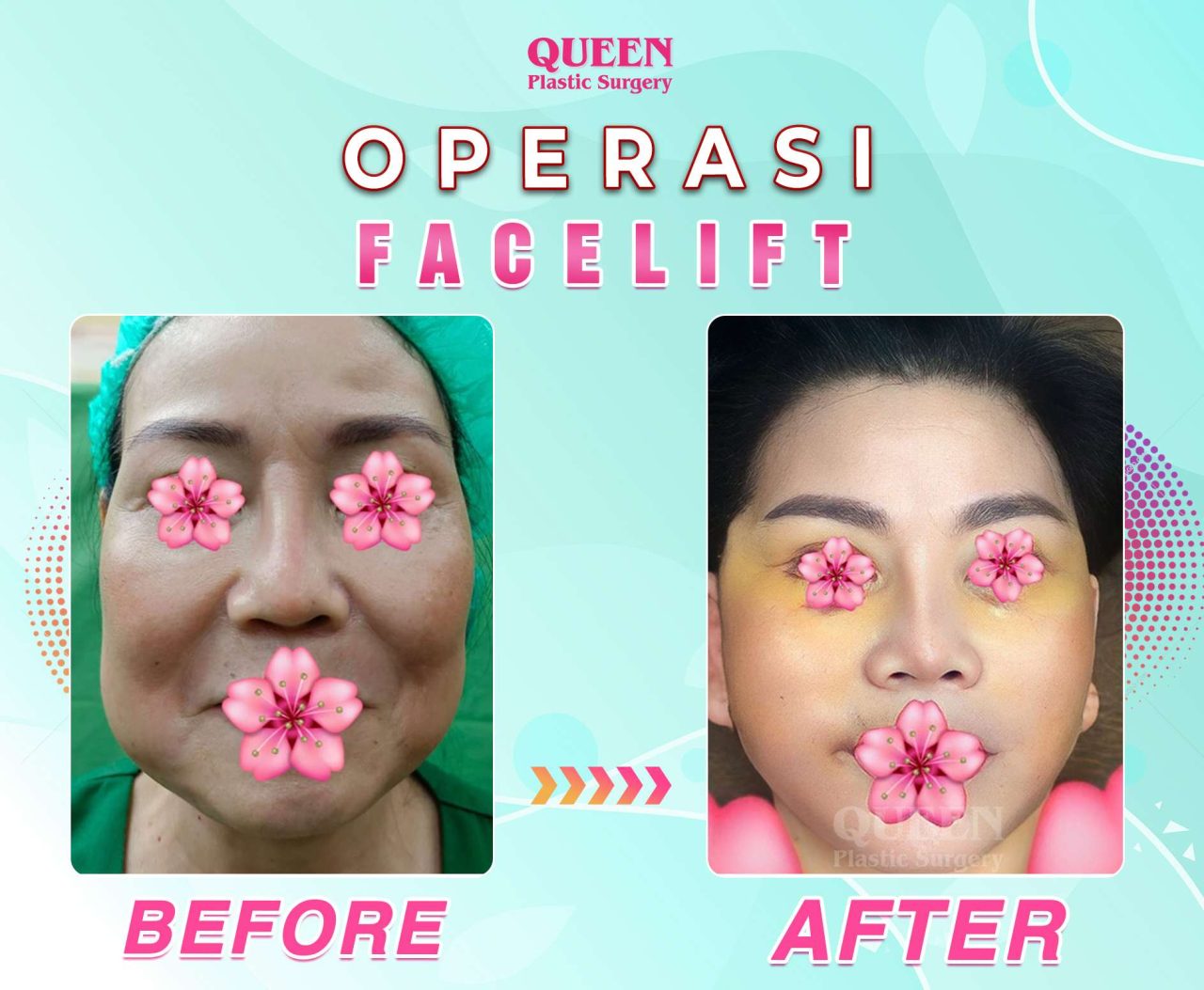 Hasil Rhinoplasty Queen Plastic Surgery, foto 4