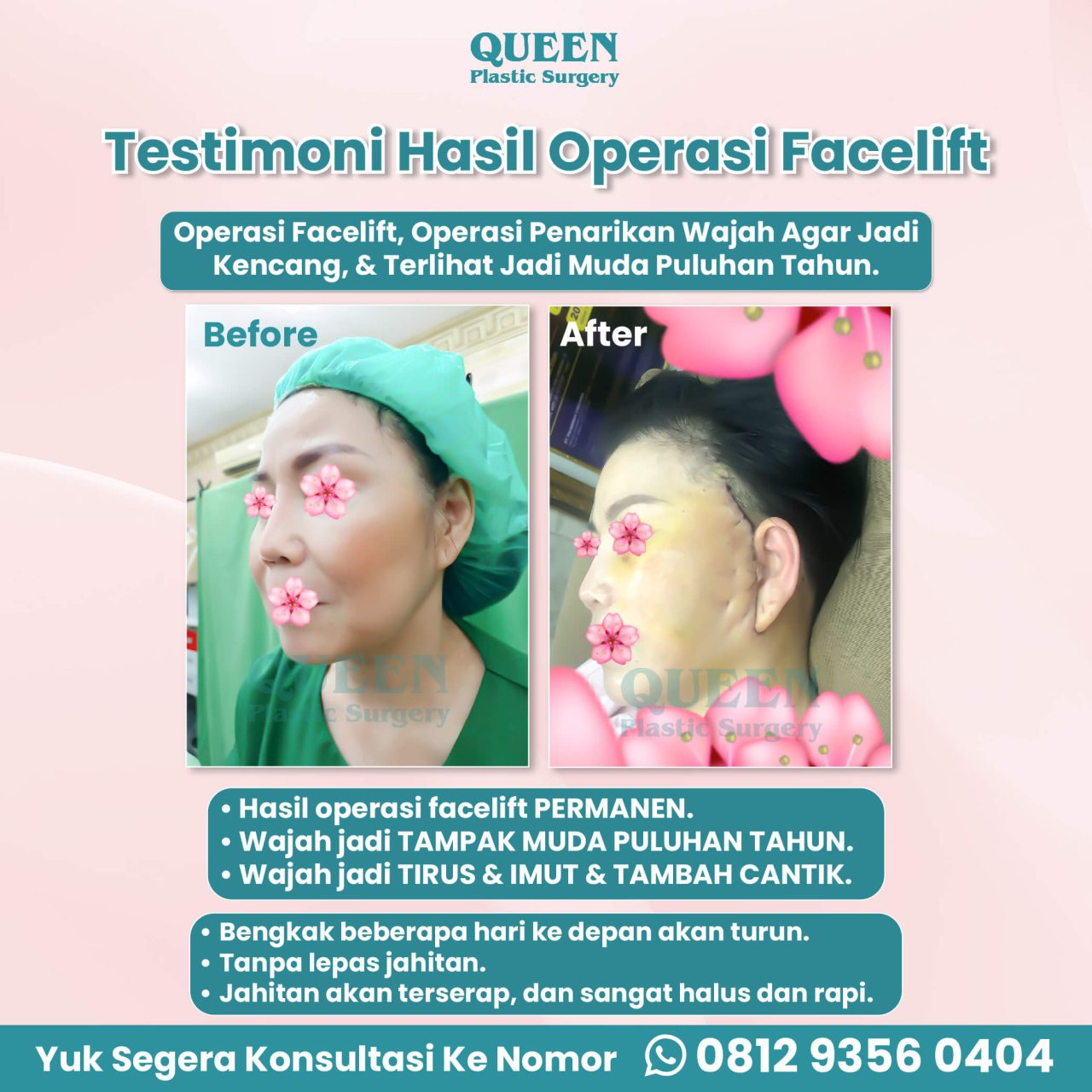Hasil Rhinoplasty Queen Plastic Surgery, foto 82