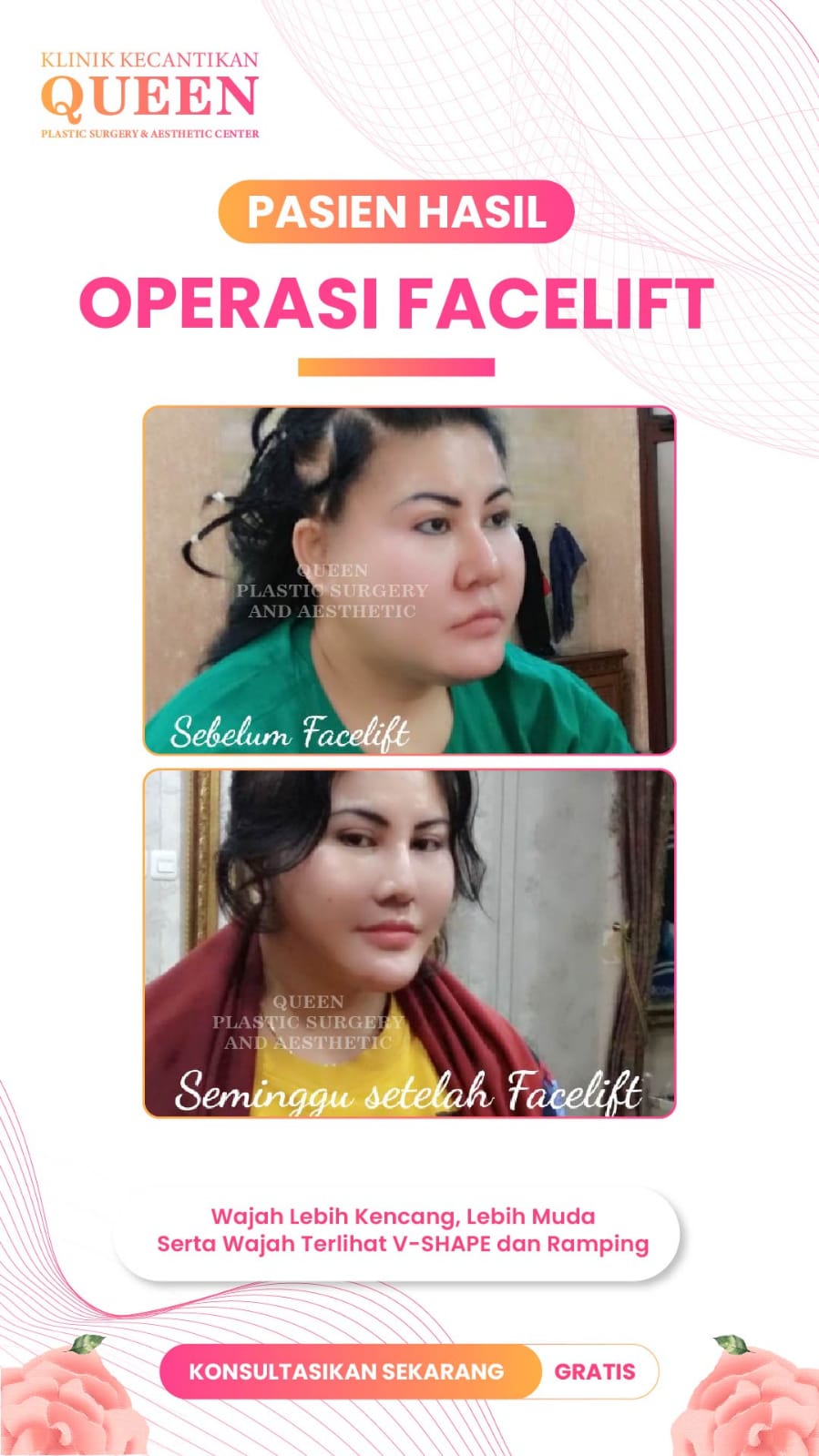 SEMUA YANG PERLU DIKETAHUI TENTANG OLAHRAGA PASCA OPERASI PLASTIK