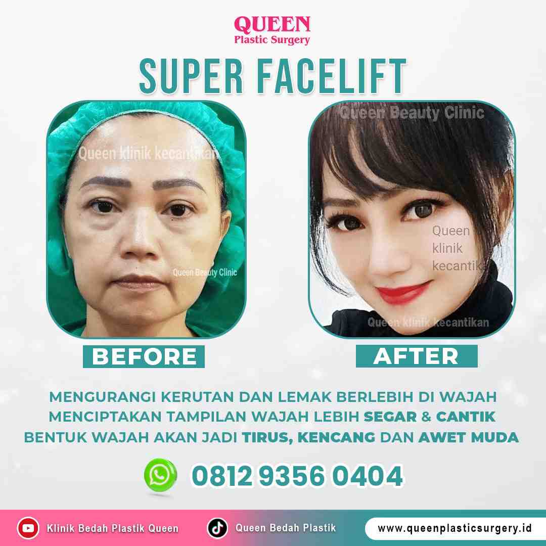 1 https://queenplasticsurgery.id/wp-content/uploads/2024/09/1-2.jpg