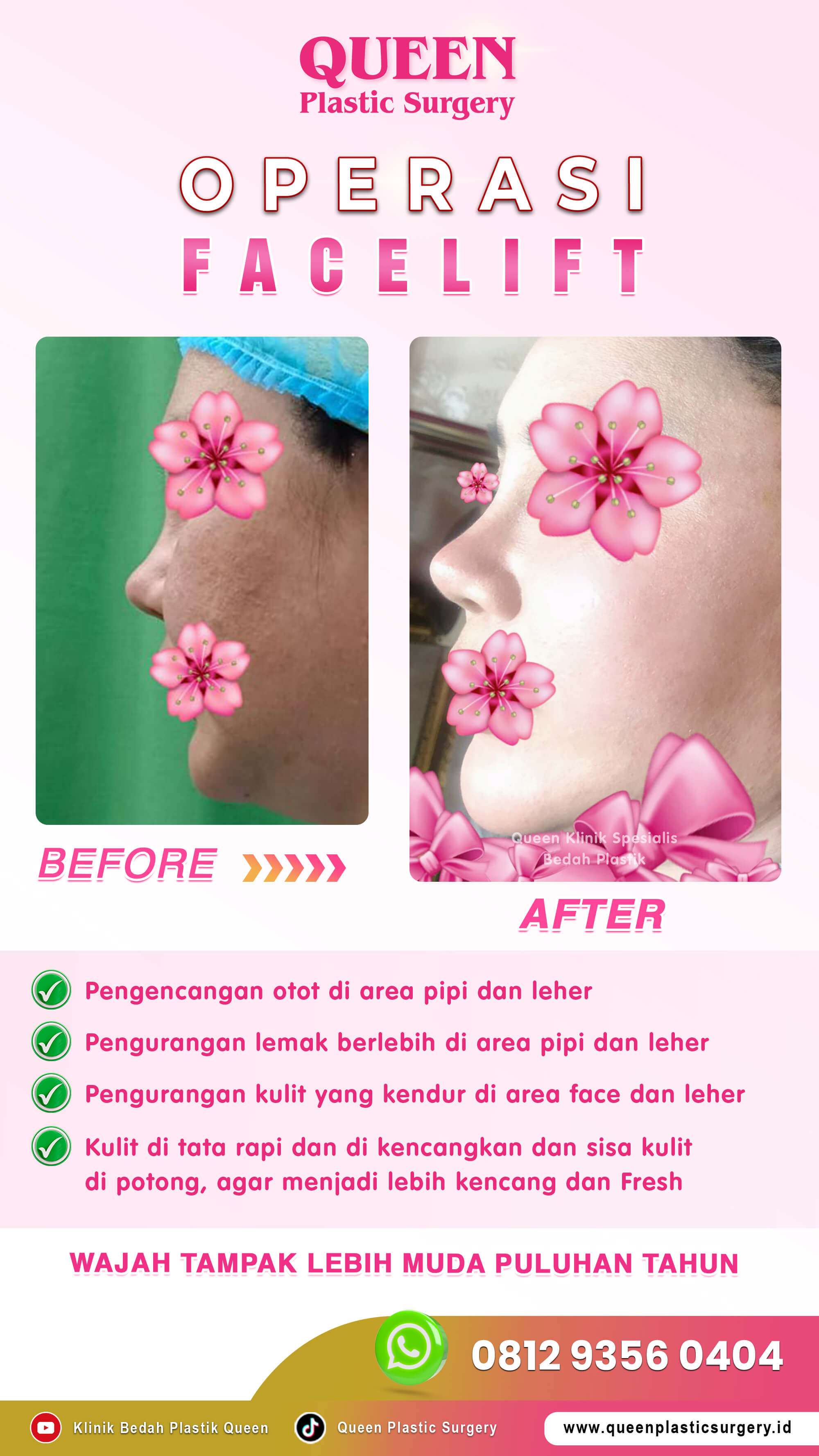 Before-After-OP-Facelift-001 (1)