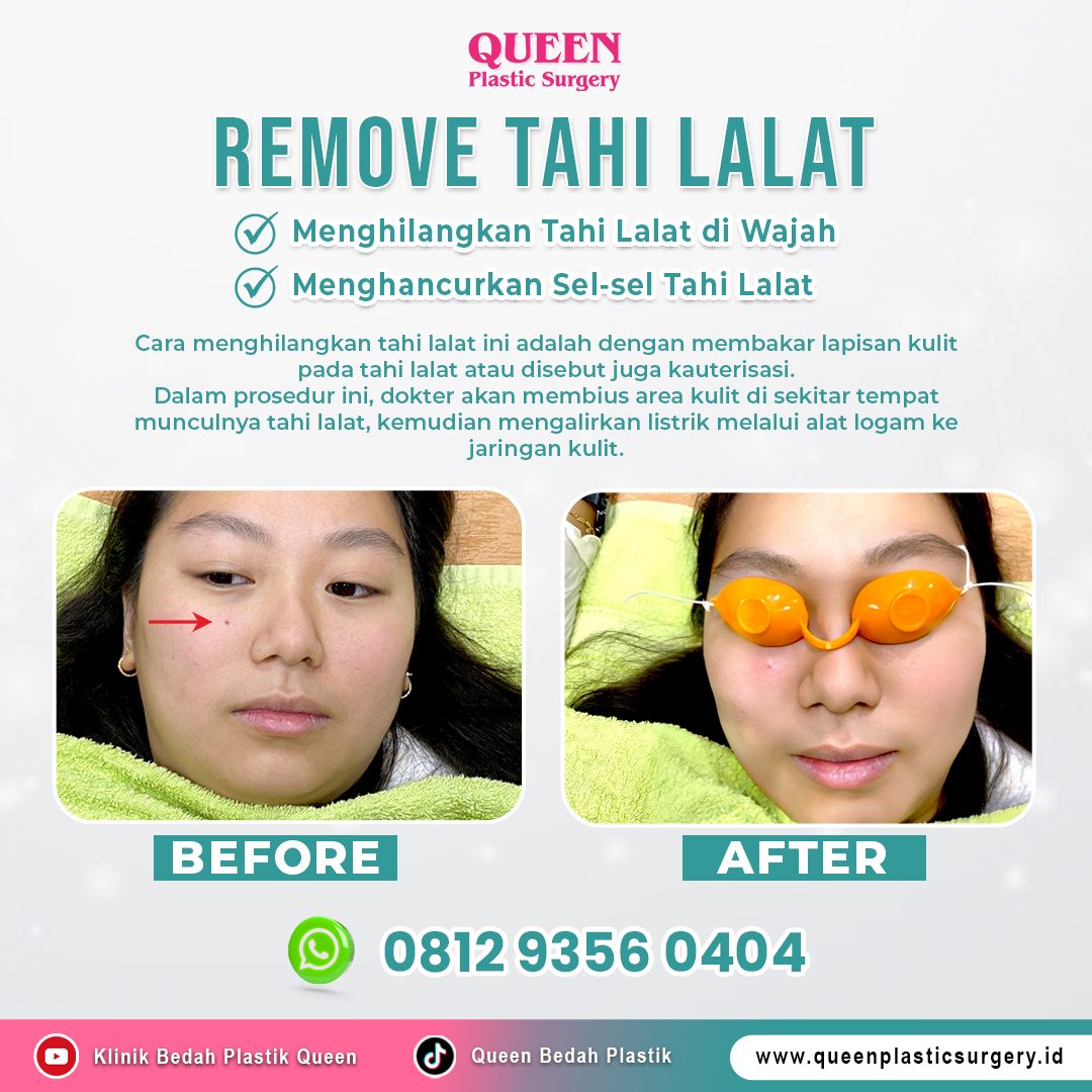Before-After-Remove-Tahi-Lalat https://queenplasticsurgery.id/wp-content/uploads/2024/09/Before-After-Remove-Tahi-Lalat.jpg