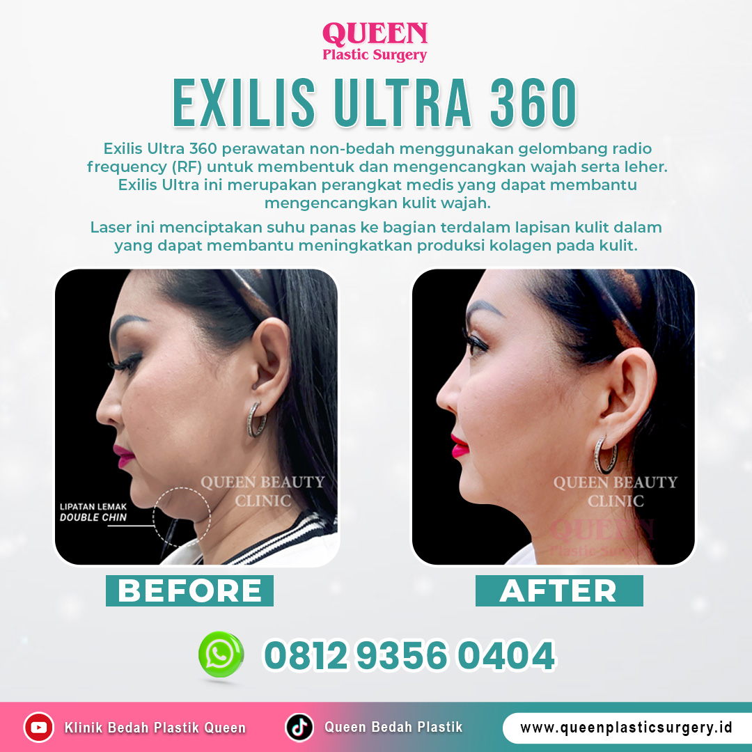 Laser-Exilis-Ultra-360 https://queenplasticsurgery.id/wp-content/uploads/2024/09/Laser-Exilis-Ultra-360.jpg