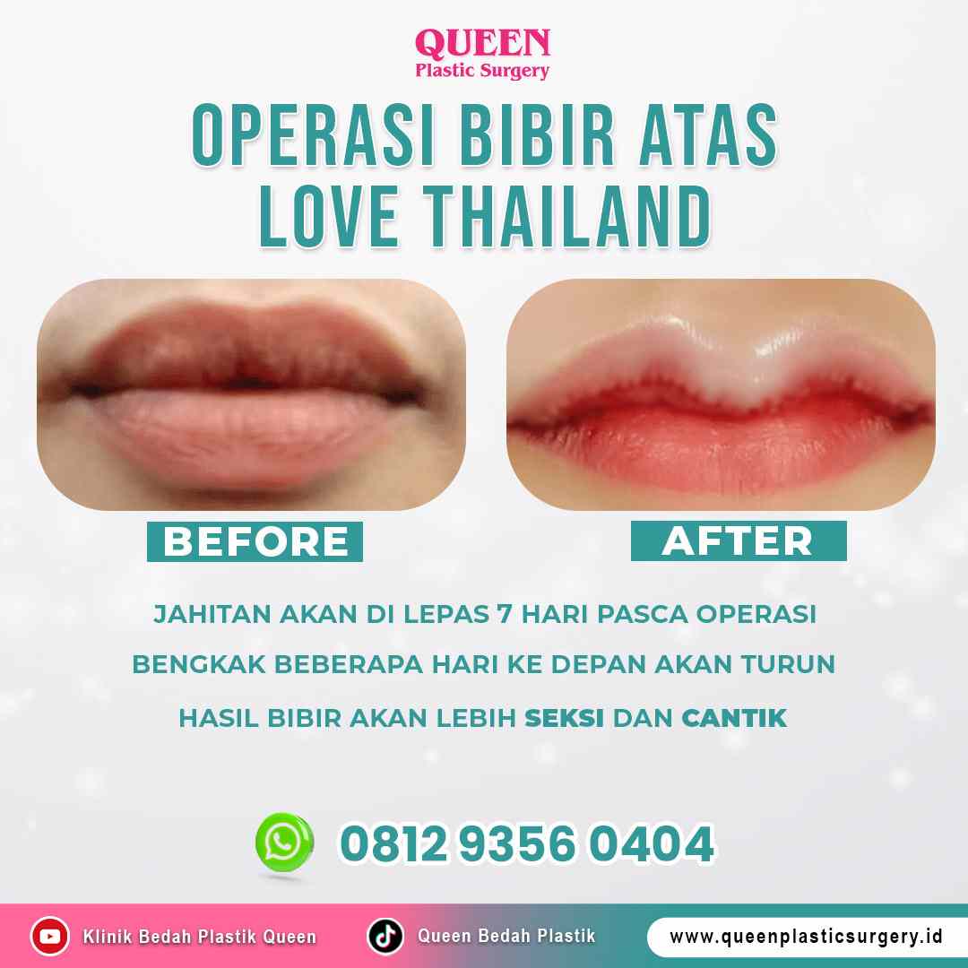 Operasi-Bibir-Atas-Love-Thailand-2 https://queenplasticsurgery.id/wp-content/uploads/2024/09/Operasi-Bibir-Atas-Love-Thailand-2.jpg