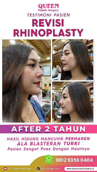 Hasil Rhinoplasty Queen Plastic Surgery, foto 68