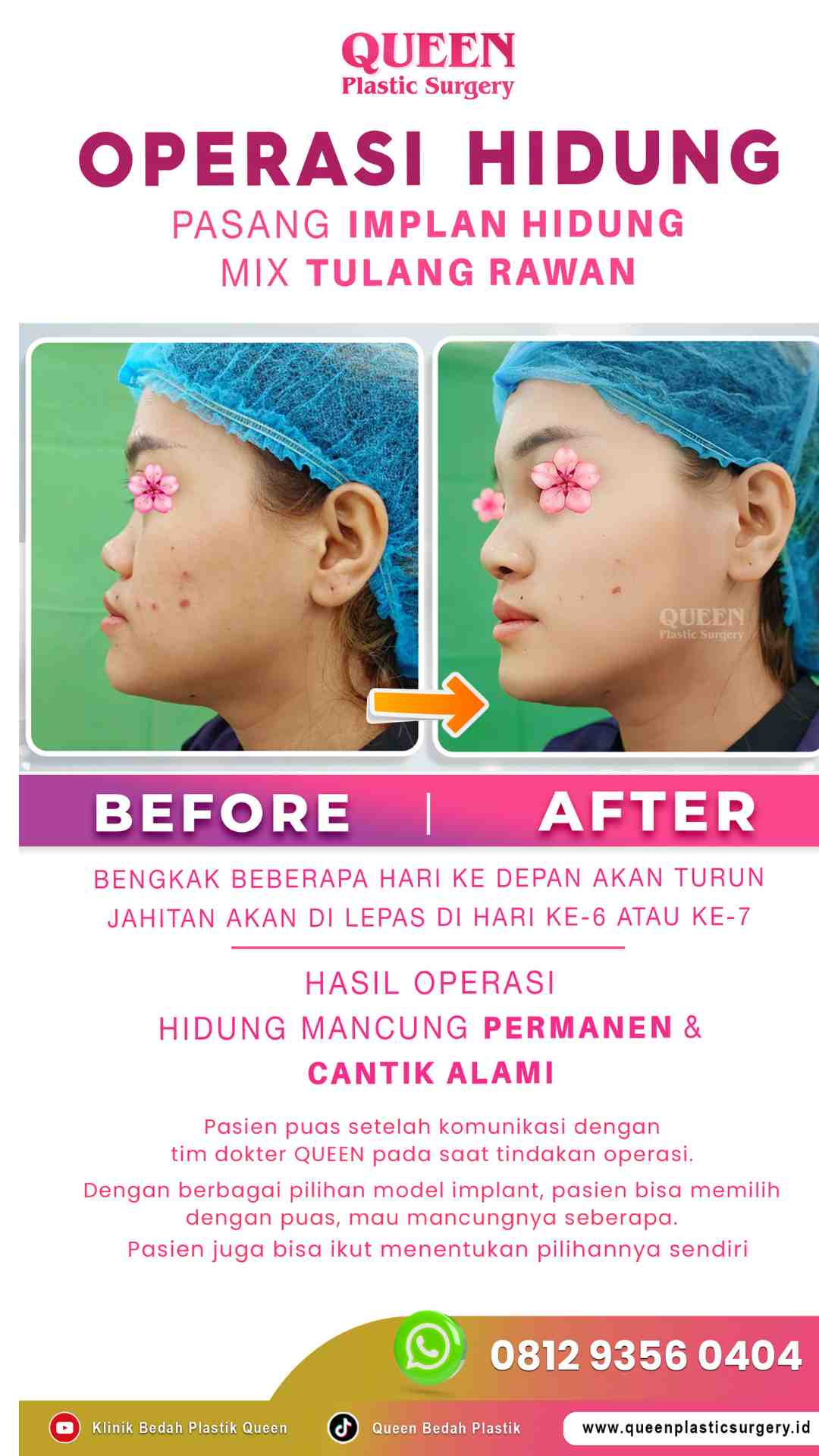 Hasil Rhinoplasty Queen Plastic Surgery, foto 61