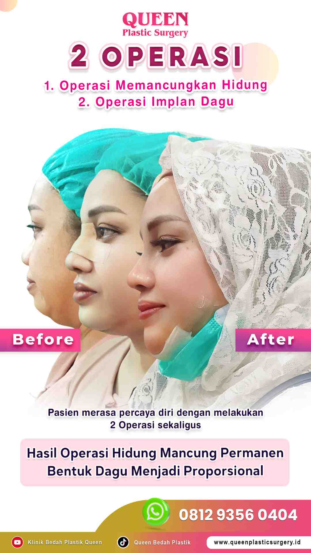 Hasil Rhinoplasty Queen Plastic Surgery, foto 45