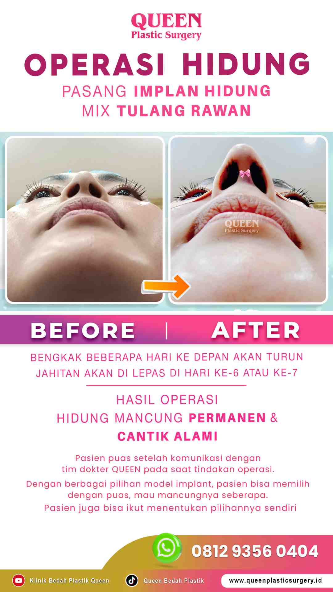 Hasil Rhinoplasty Queen Plastic Surgery, foto 62